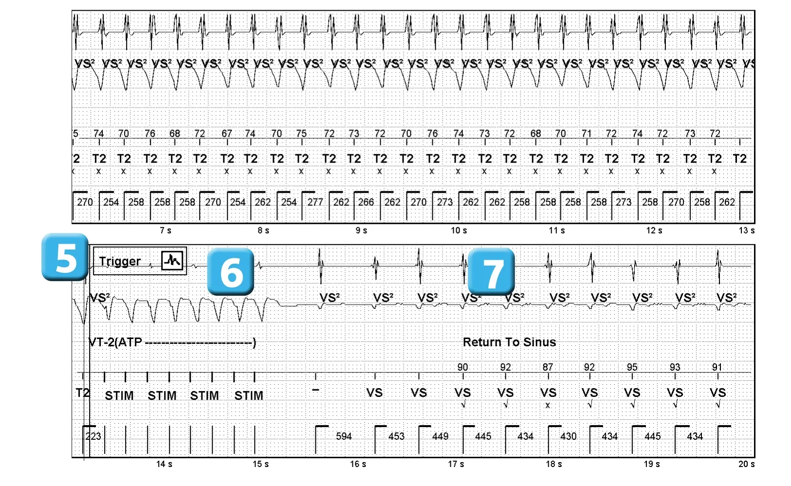 Électrogramme Abbott ICD, segment 2 sur 2 — Compétition entre les différents compteurs de détection