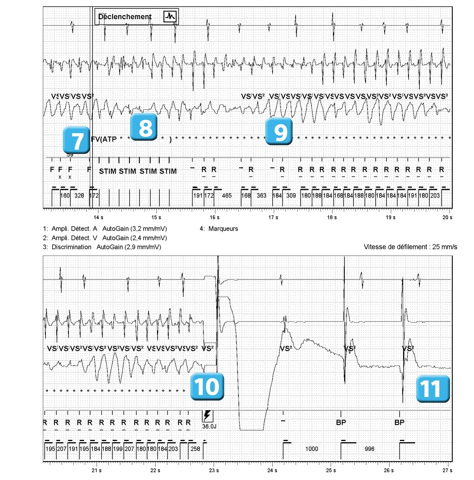 Électrogramme Abbott ICD, segment 3 sur 3 — Classification des cycles et sous-détection ventriculaire lors d’un épisode de FV