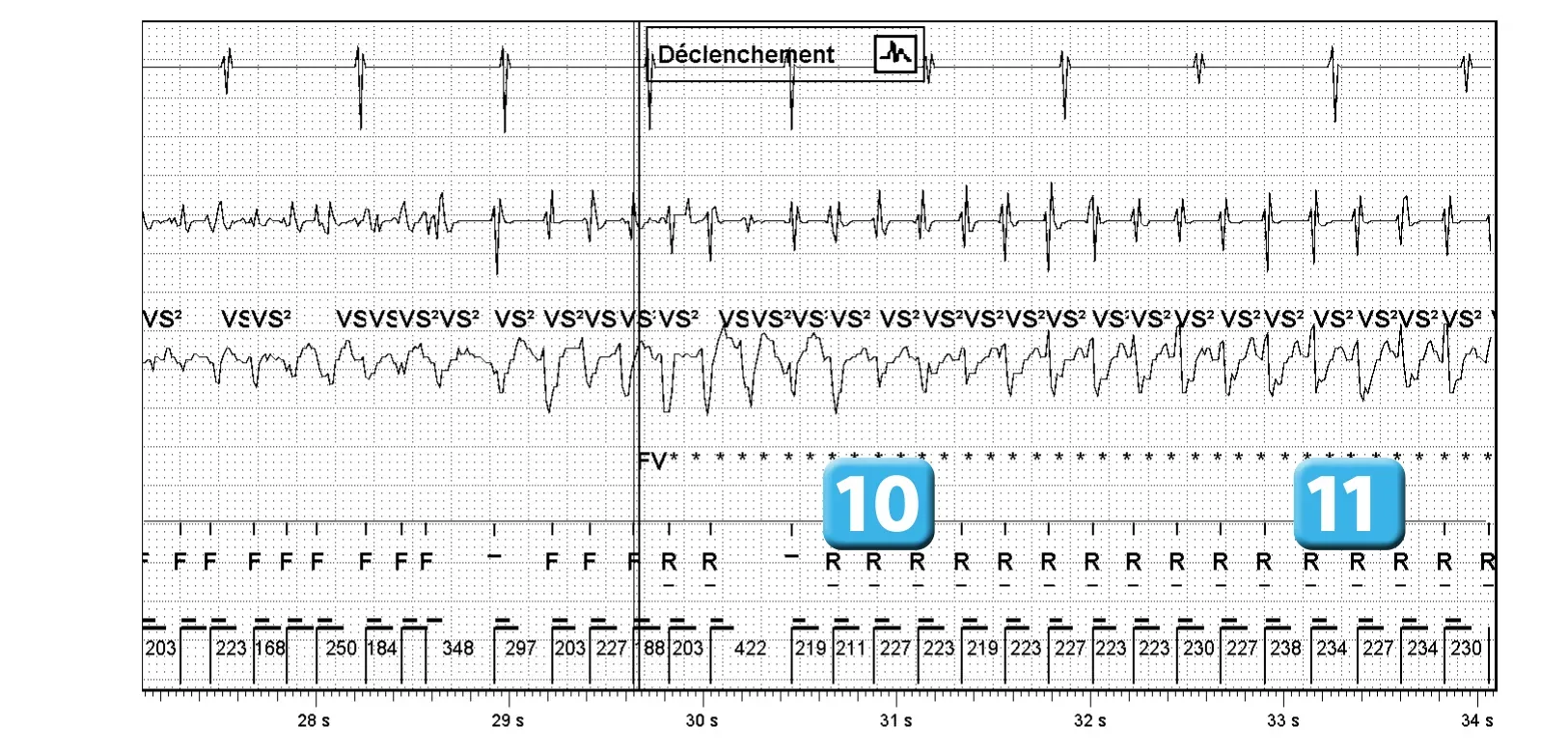 Électrogramme Abbott ICD, segment 3 sur 5 — Compteur de redétection après accélération d’une TV en zone de FV