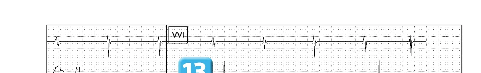 Électrogramme Abbott ICD, segment 5 sur 5 — Compteur de redétection après accélération d’une TV en zone de FV
