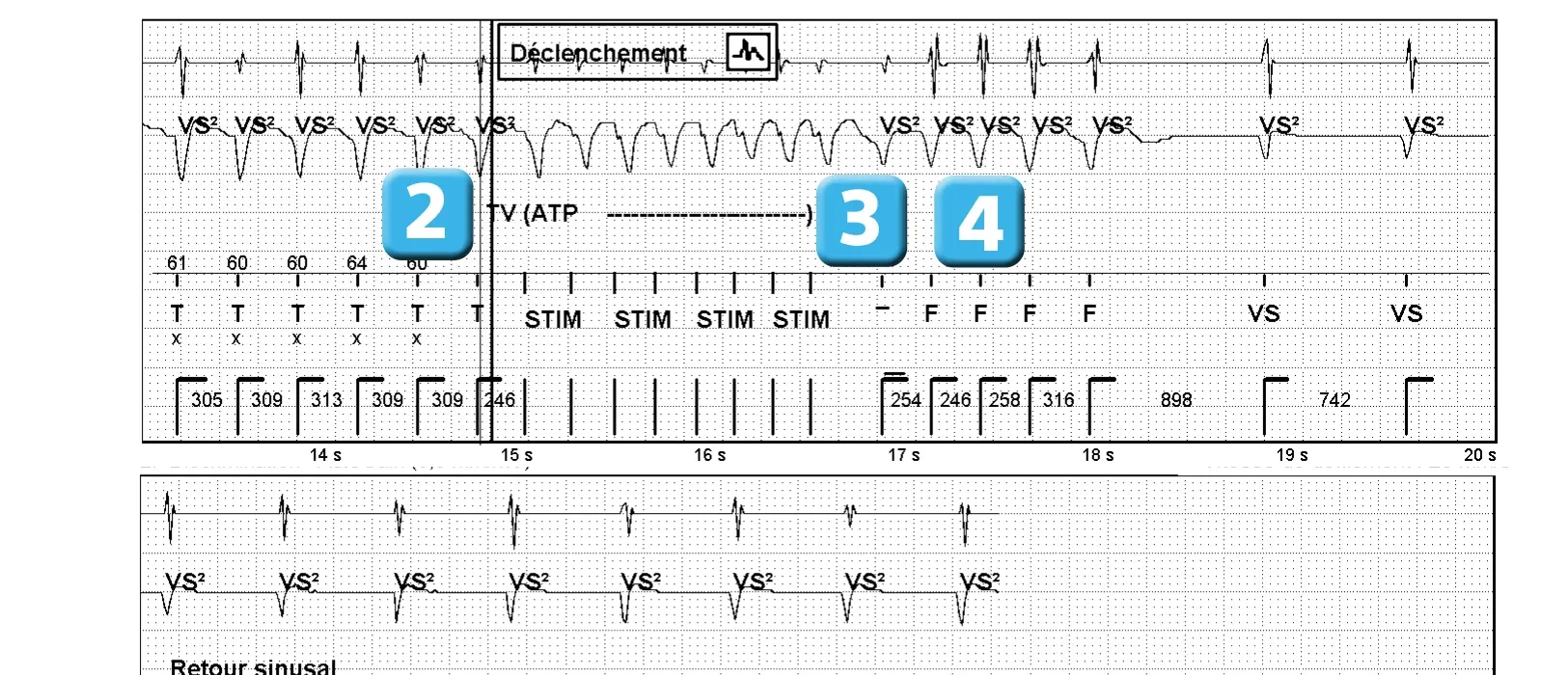 Électrogramme Abbott ICD, segment 1 sur 1 — Nouvelles recommandations et nombre de cycles en détection initiale