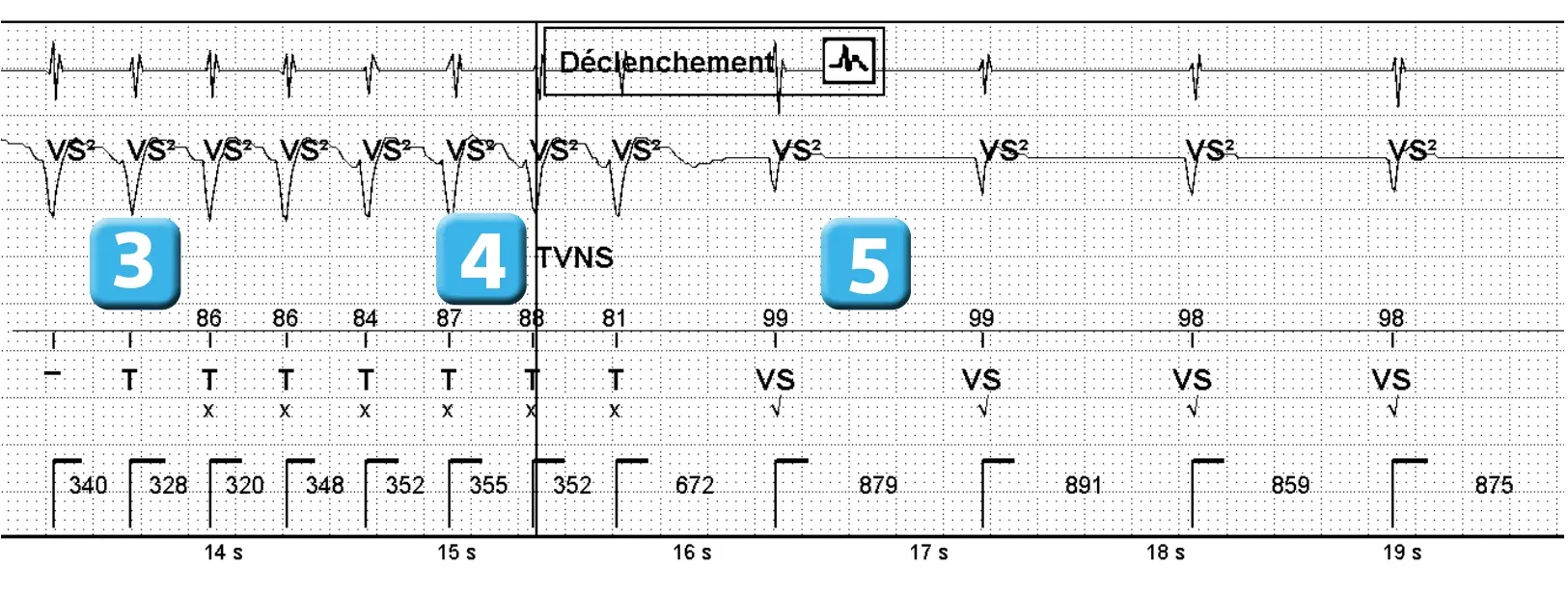 Électrogramme Abbott ICD, segment 3 sur 3 — Nouvelles recommandations et nombre de cycles en détection initiale