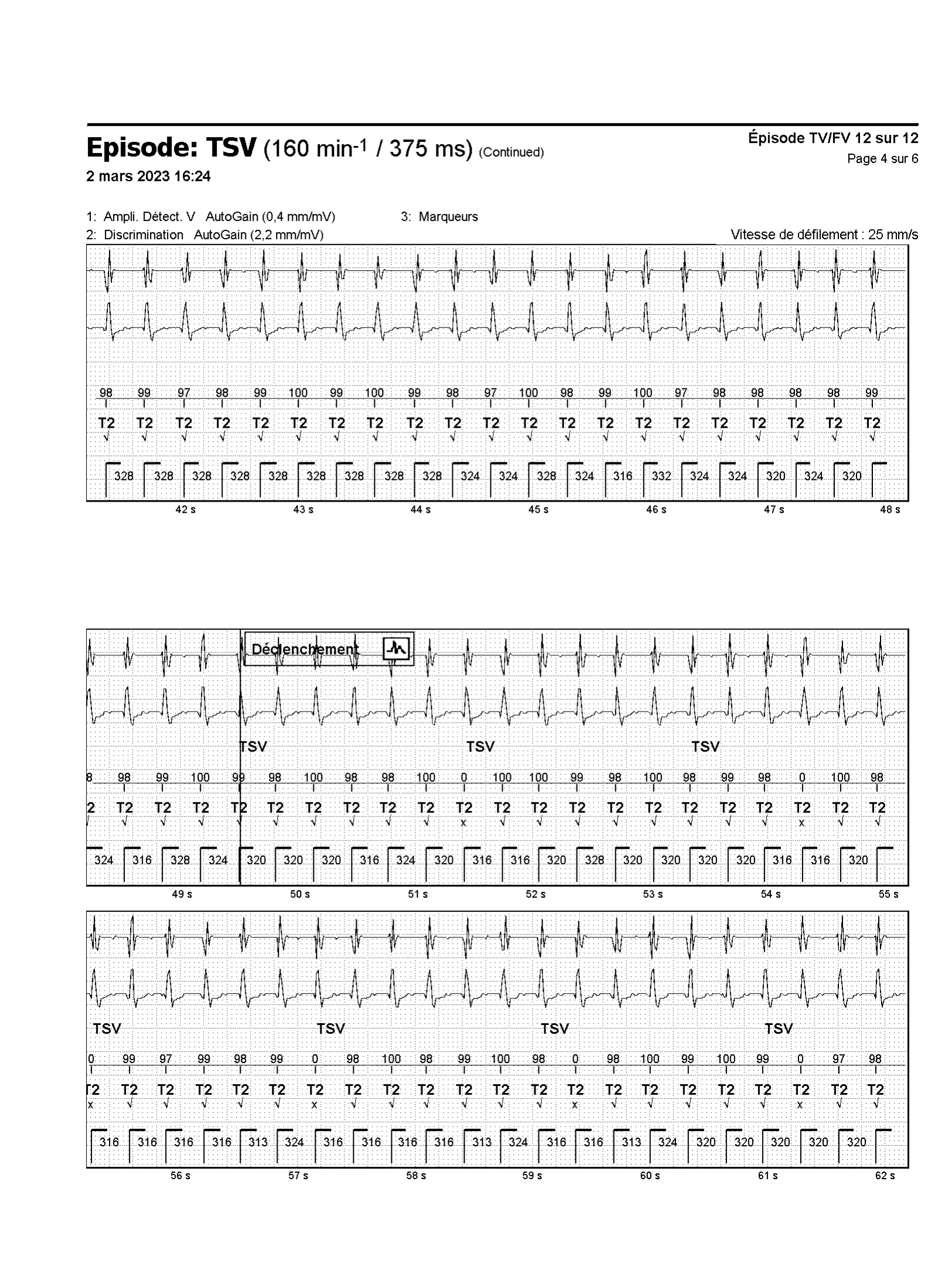 Episode de tachycardie sinusale et discrimination simple chambre