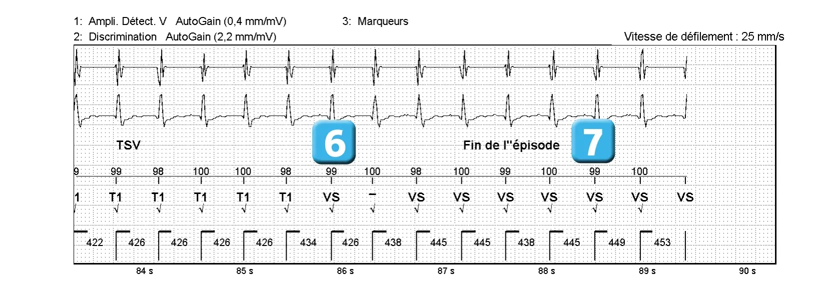 Électrogramme Abbott ICD, segment 4 sur 4 — Episode de tachycardie sinusale et discrimination simple chambre