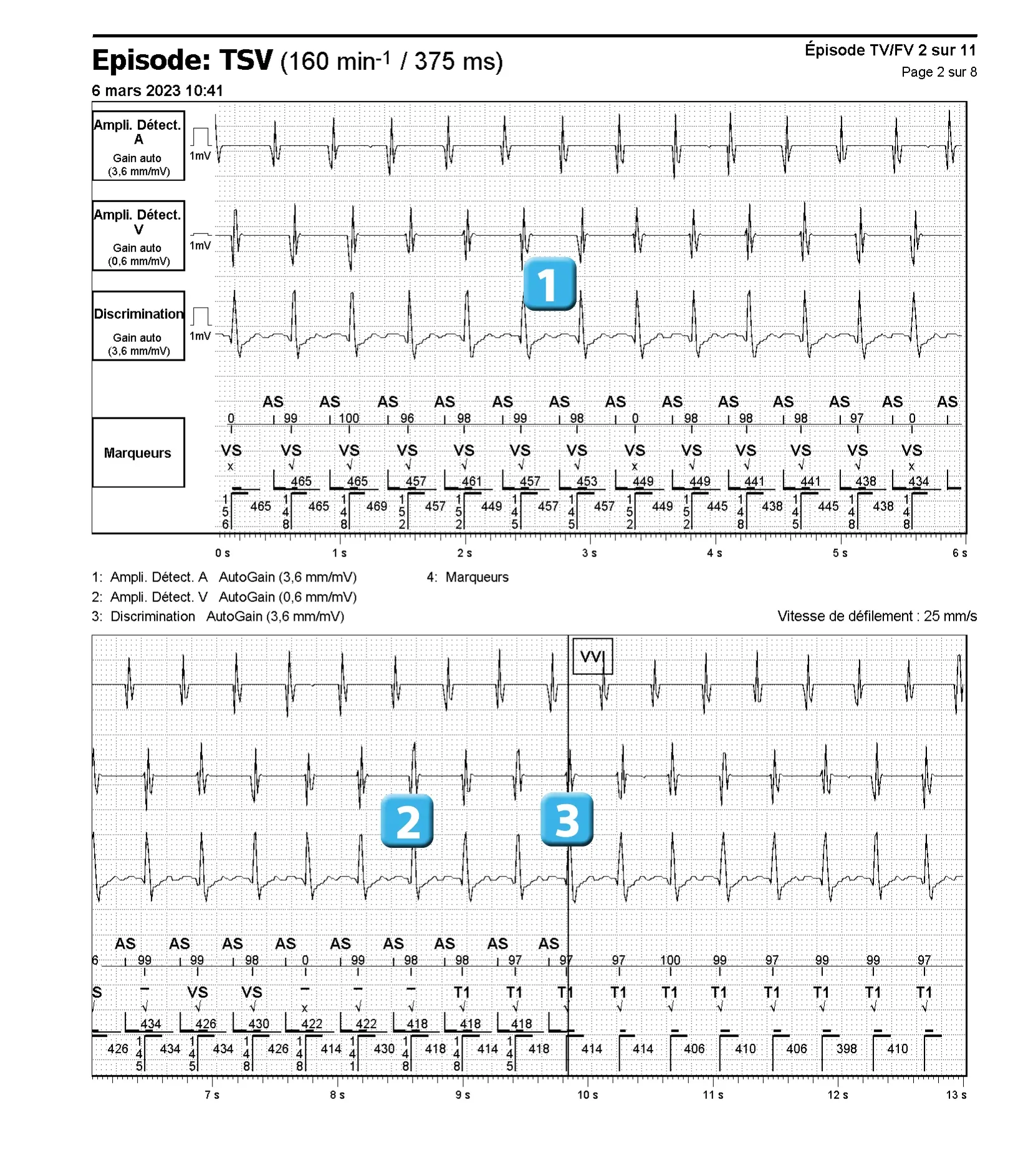 Électrogramme Abbott ICD, segment 1 sur 4 — Discrimination double chambre et branche V = A