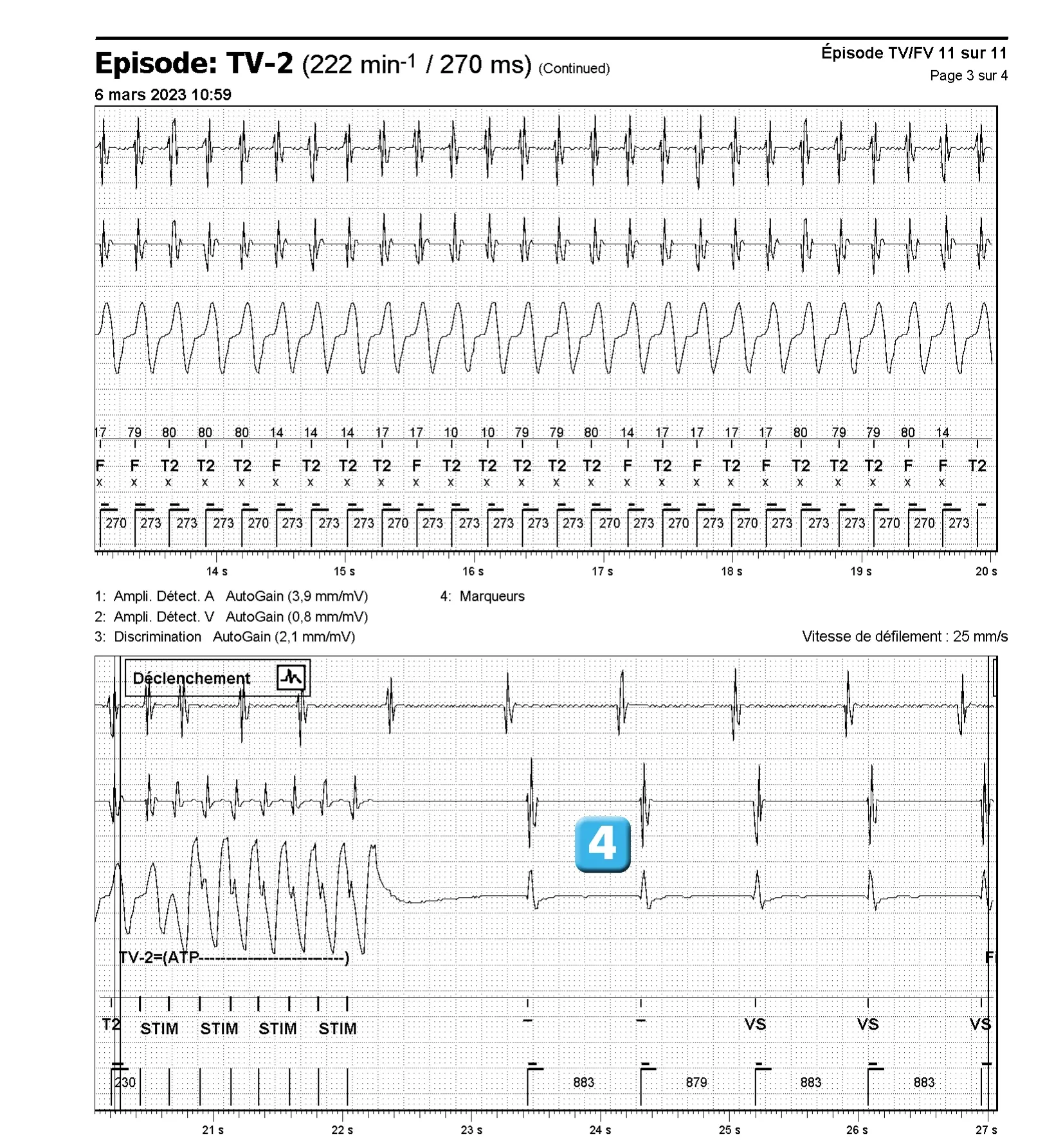 Électrogramme Abbott ICD, segment 3 sur 4 — Discrimination double chambre et branche V = A