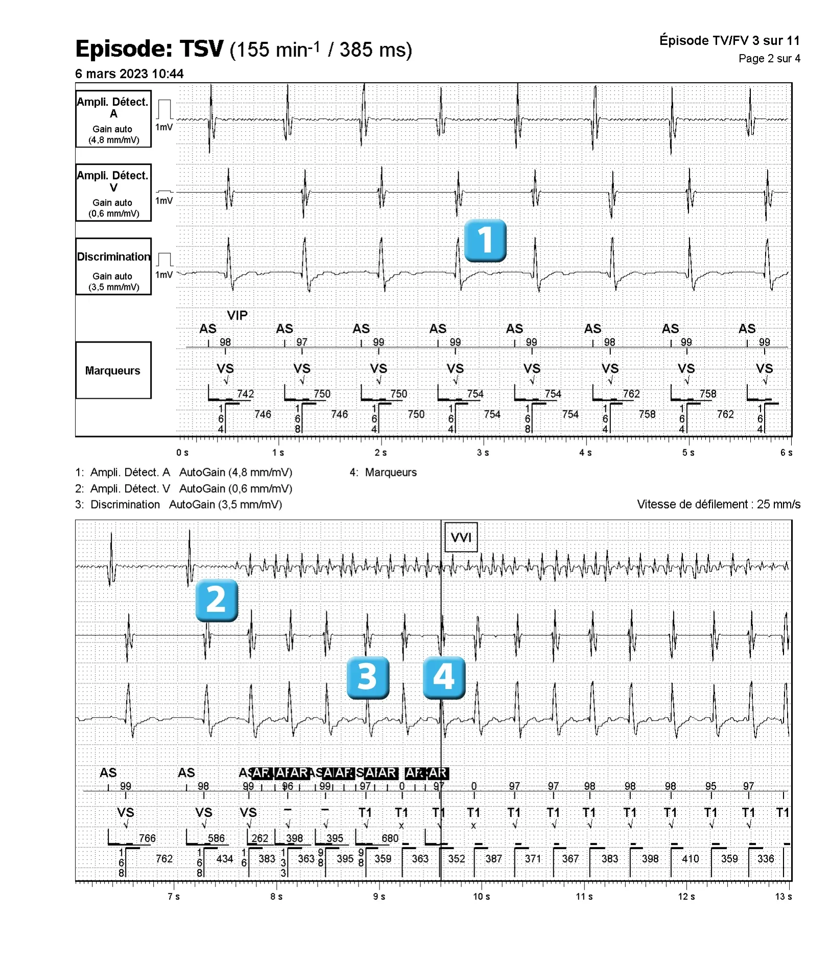 Électrogramme Abbott ICD, segment 1 sur 3 — Discrimination double chambre et branche V < A