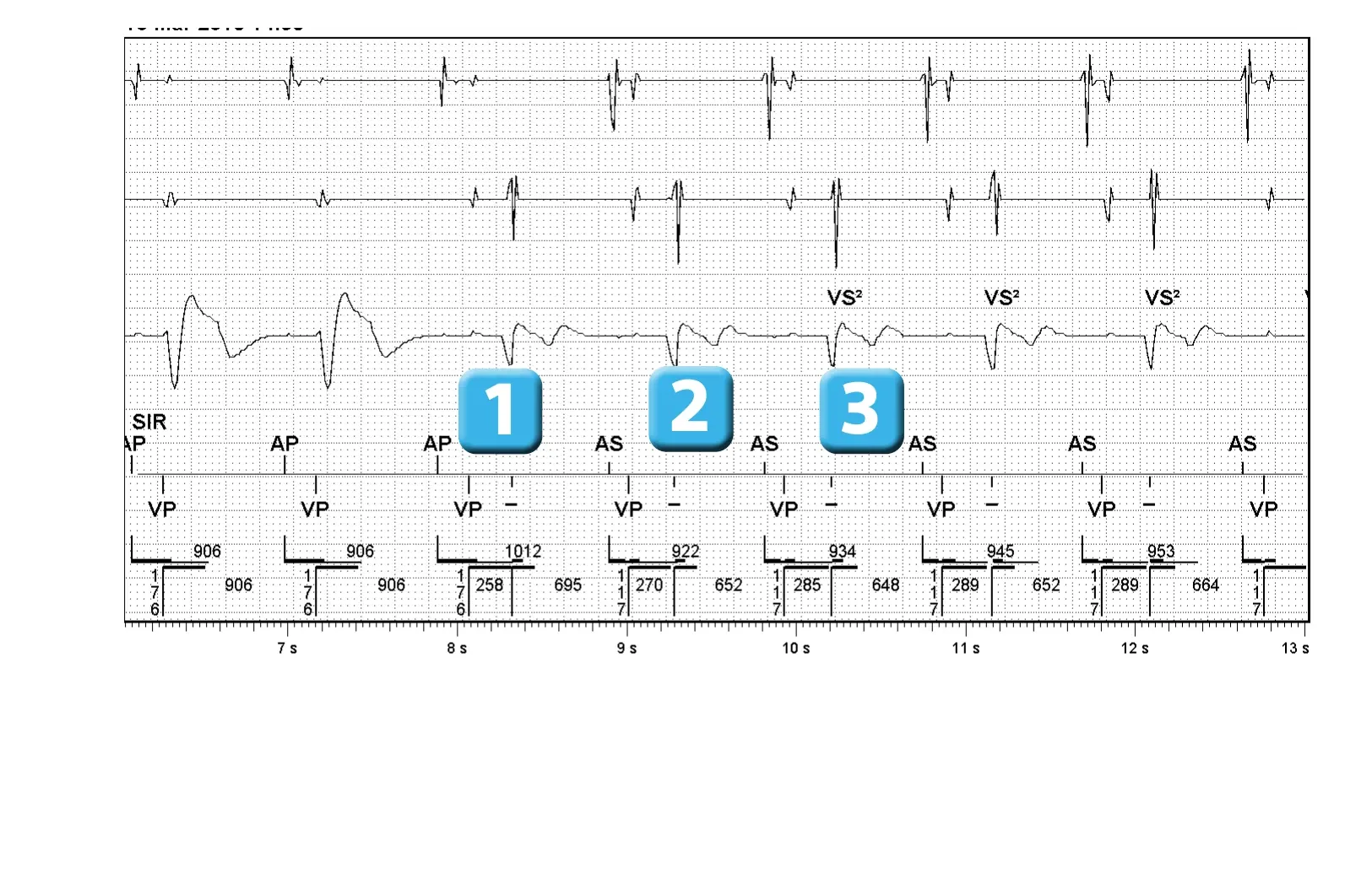 Électrogramme Abbott ICD, segment 1 sur 2 — Algorithme SecureSense™ et perte de capture ventriculaire droite