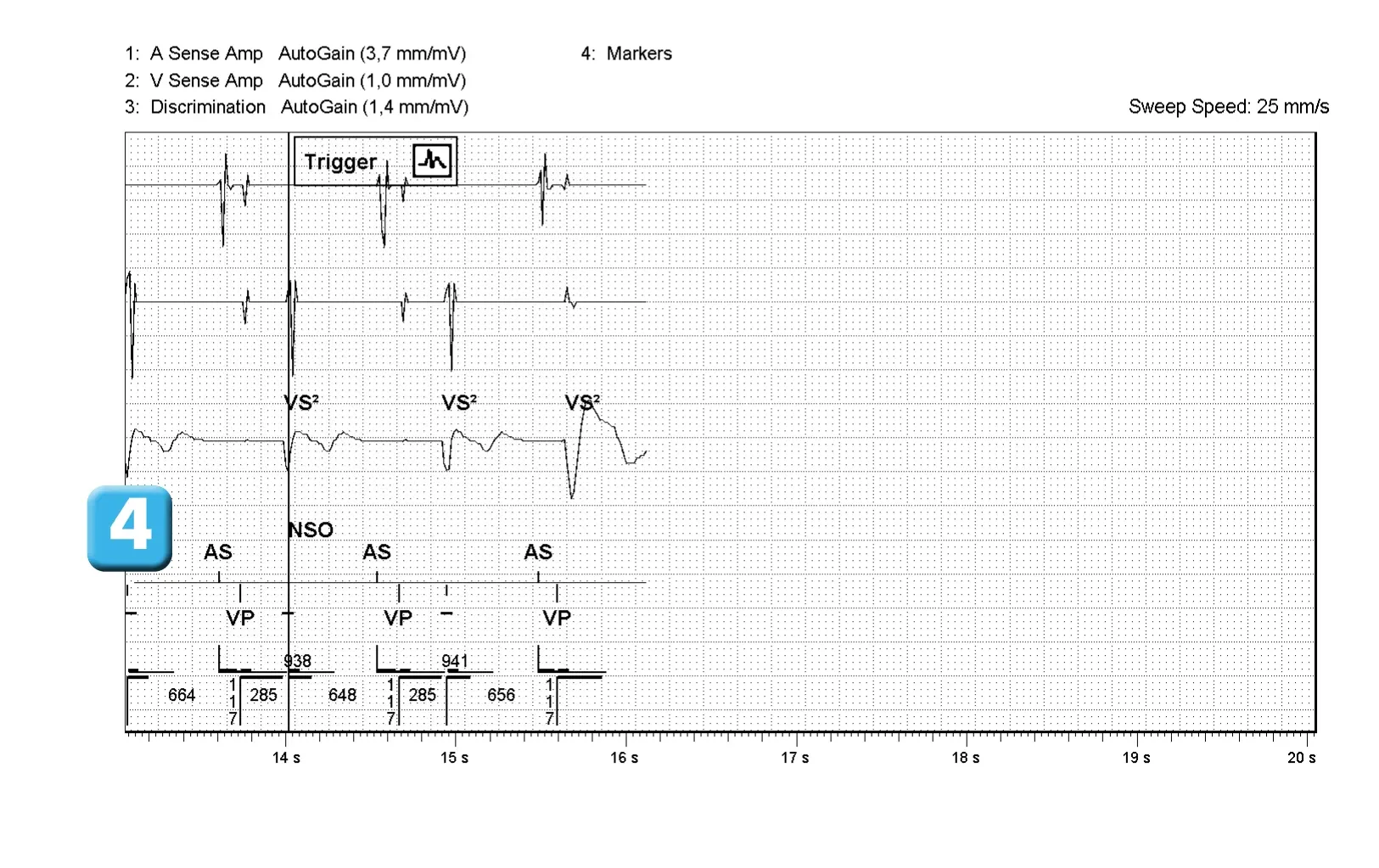 Électrogramme Abbott ICD, segment 2 sur 2 — Algorithme SecureSense™ et perte de capture ventriculaire droite