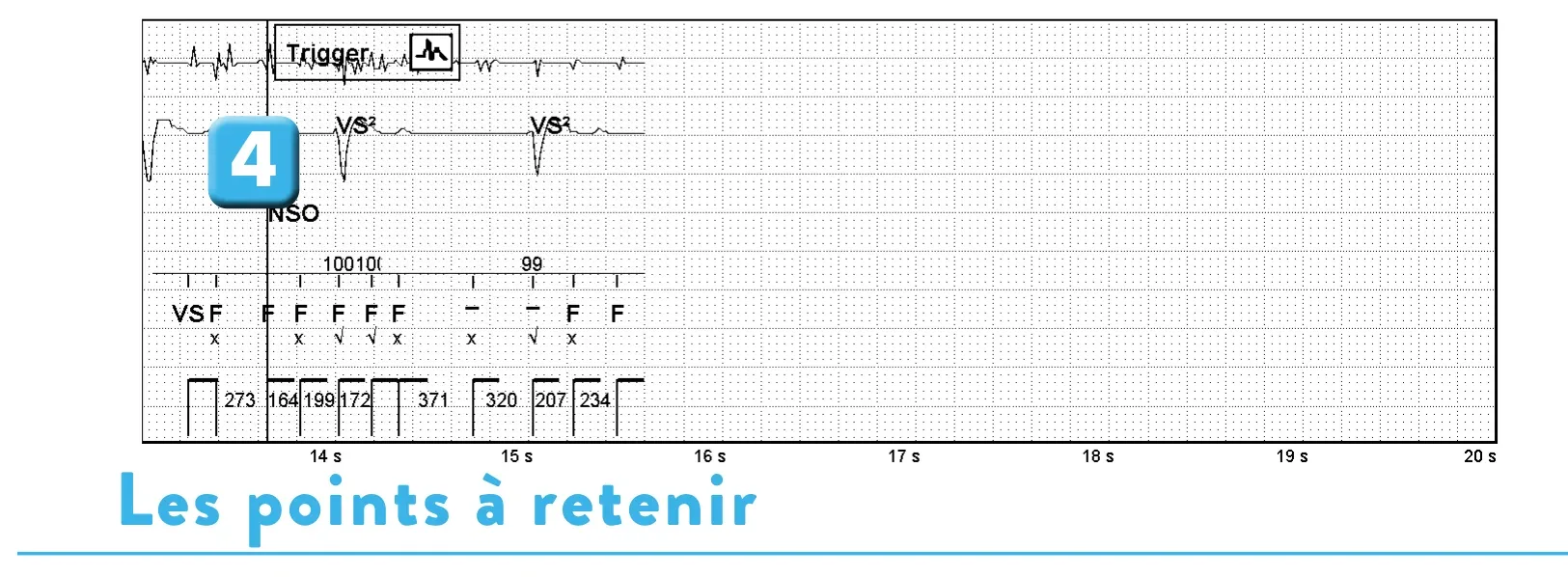 Électrogramme Abbott ICD, segment 3 sur 3 — Dispositif récent, dysfonction de sonde et algorithme SecureSense™