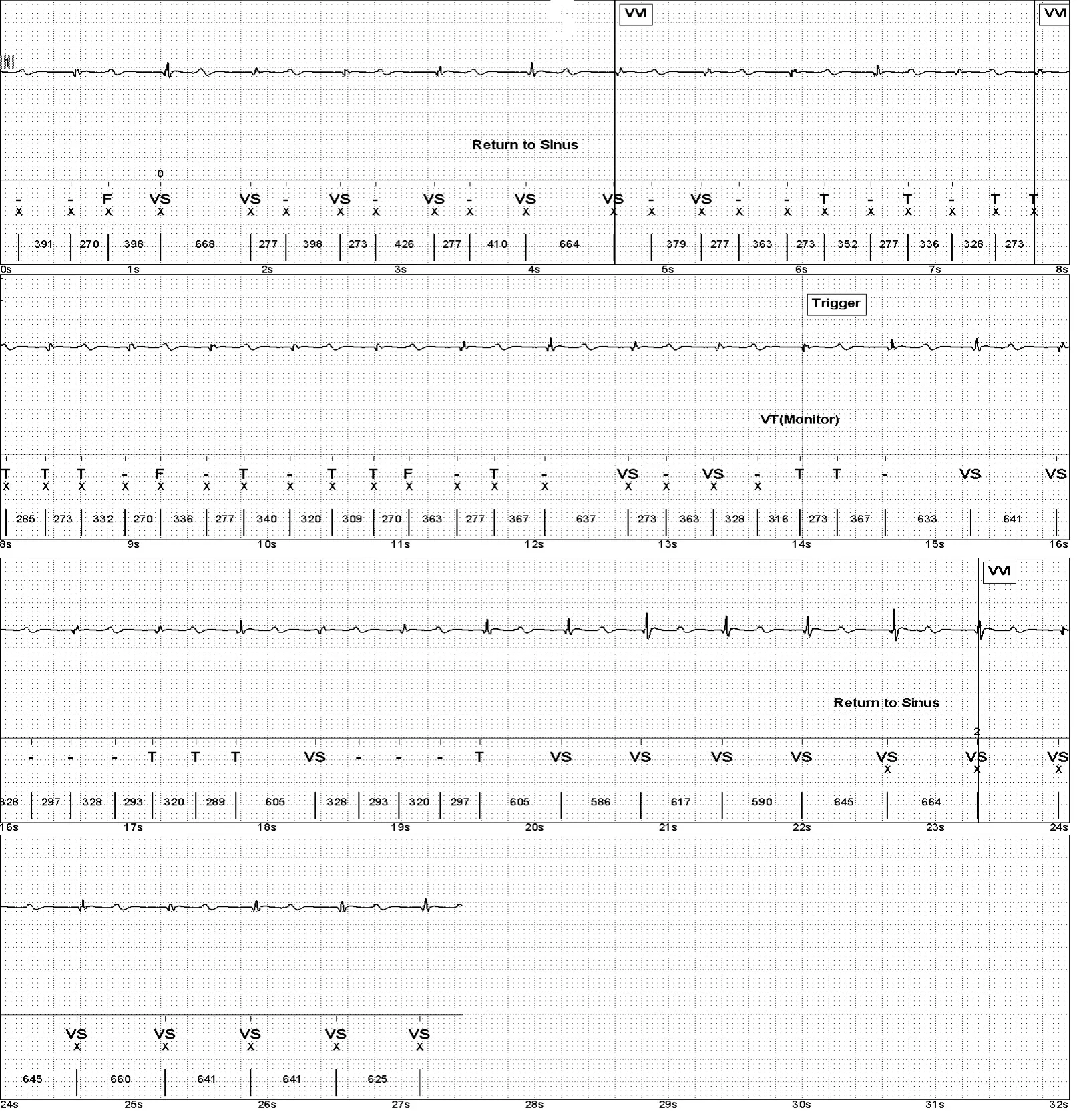 Électrogramme Abbott ICD, segment 1 sur 1 — Surdétection de l’onde T sur un modèle ancien