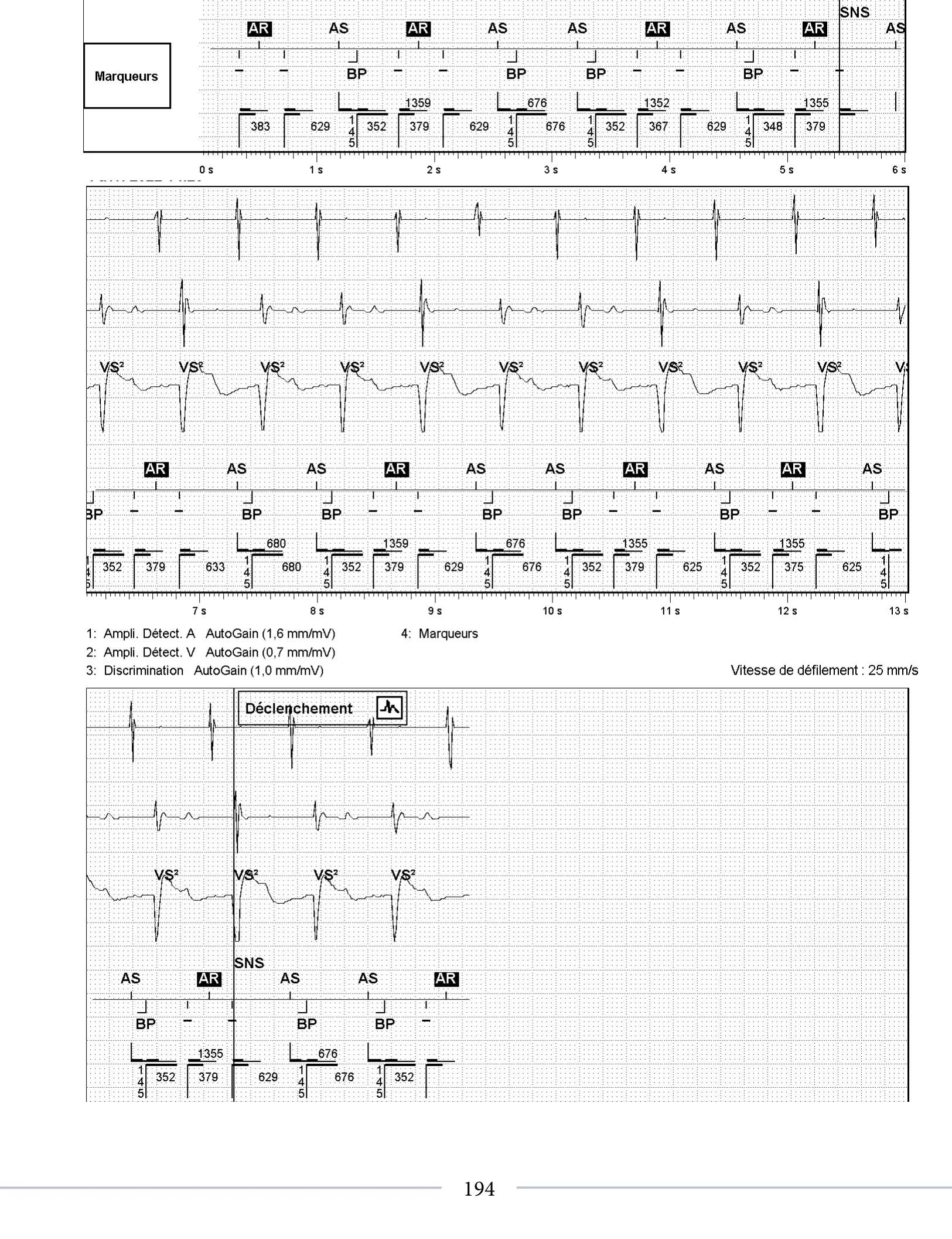 Dispositif récent, surdétection de l’onde T post-stimulation et algorithme SecureSense™