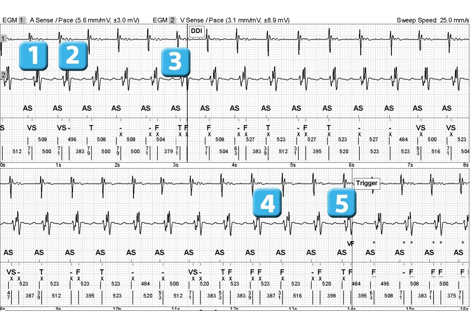 Électrogramme Abbott ICD, segment 1 sur 2 — Double comptage de l’onde R sur un modèle ancien
