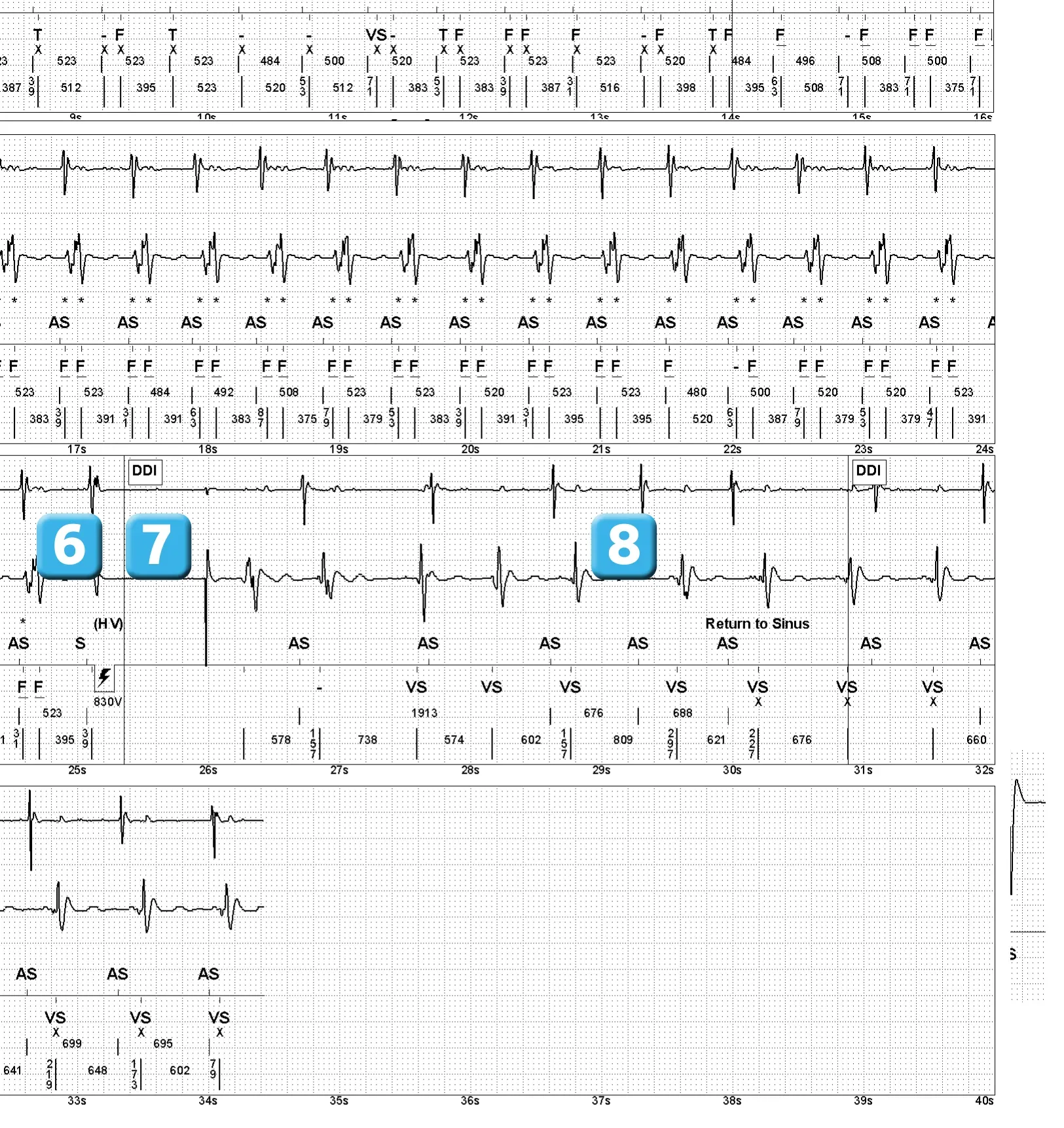 Électrogramme Abbott ICD, segment 2 sur 2 — Double comptage de l’onde R sur un modèle ancien