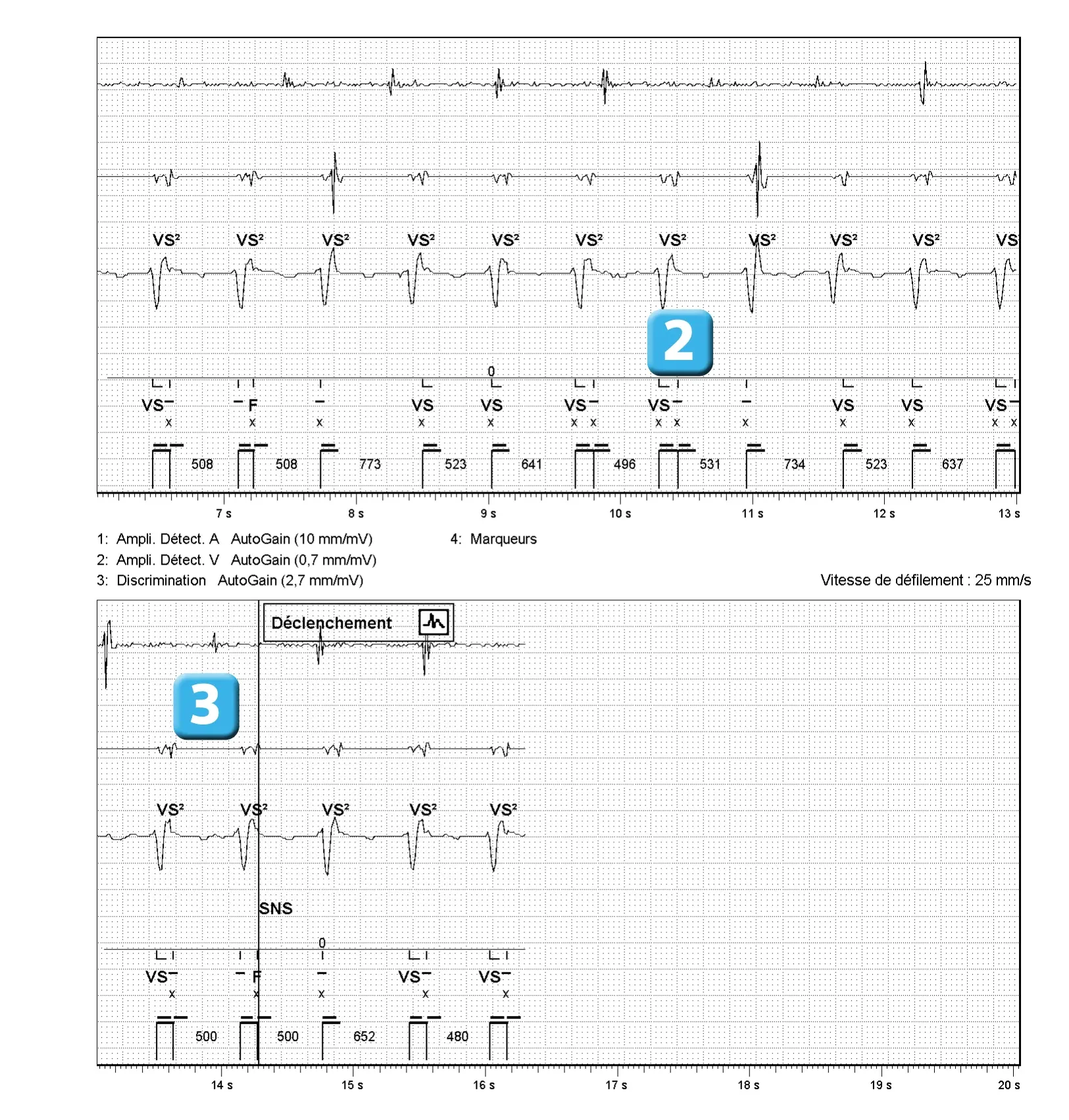 Électrogramme Abbott ICD, segment 2 sur 2 — Dispositif récent, double comptage de l’onde R et algorithme SecureSense™