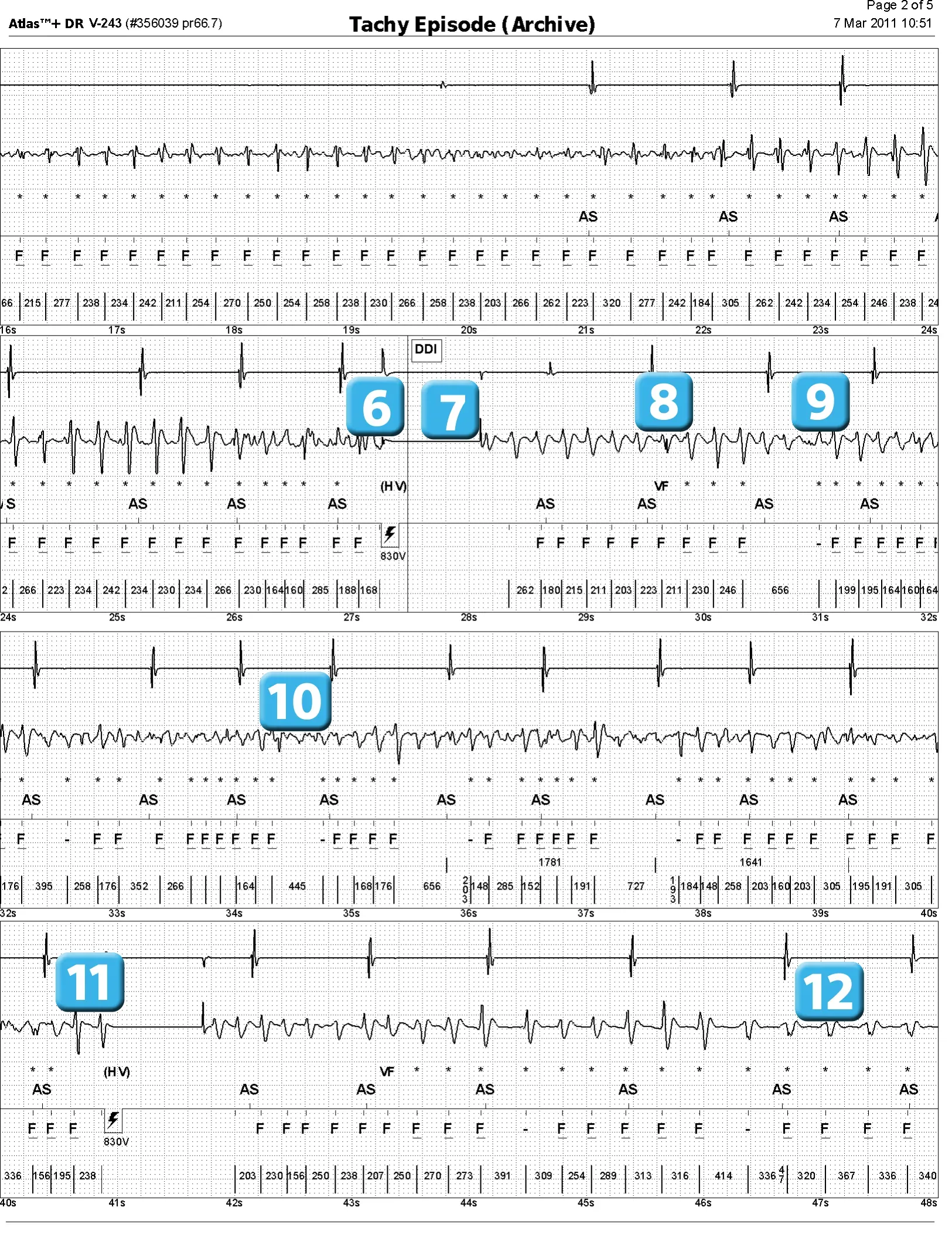 Électrogramme Abbott ICD, segment 2 sur 4 — Episode de fibrillation ventriculaire et seuil de défibrillation élevé