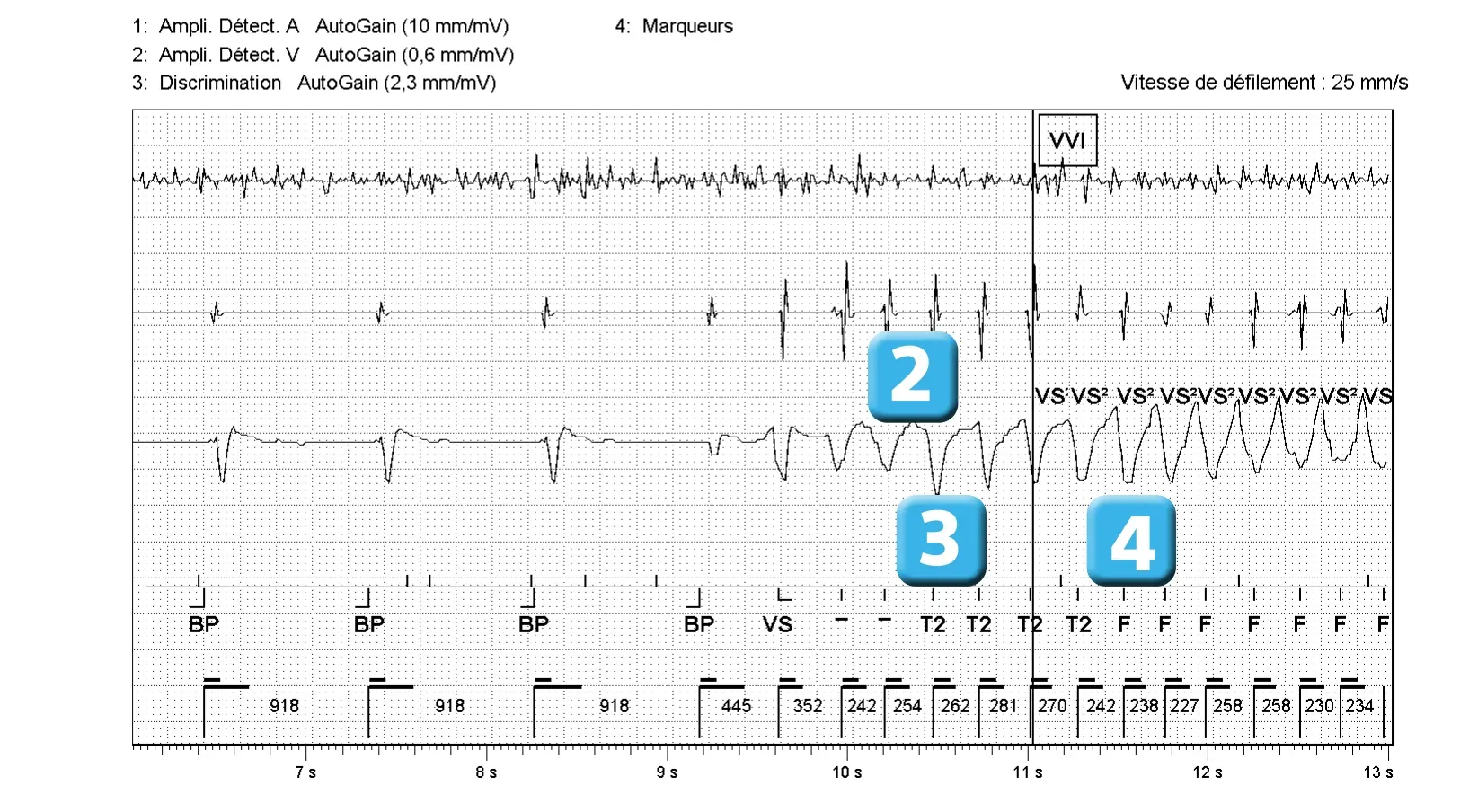 Électrogramme Abbott ICD, segment 2 sur 4 — Dysfonction de sonde et algorithme DynamicTx™