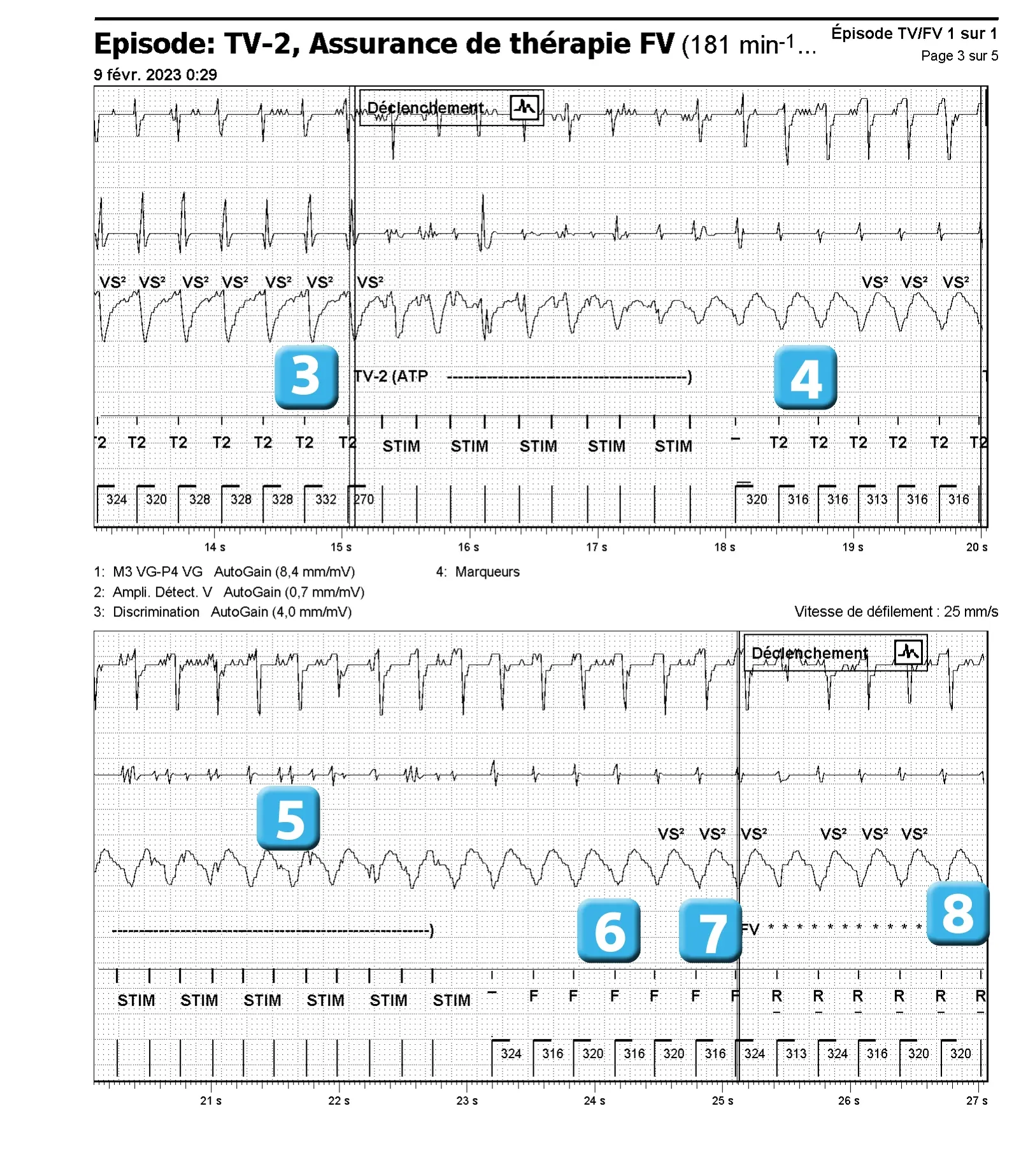 Électrogramme Abbott ICD, segment 2 sur 4 — Activation de l’algorithme VFTA pour favoriser la délivrance d’un choc électrique lors d’un épisode d’arythmie ventriculaire