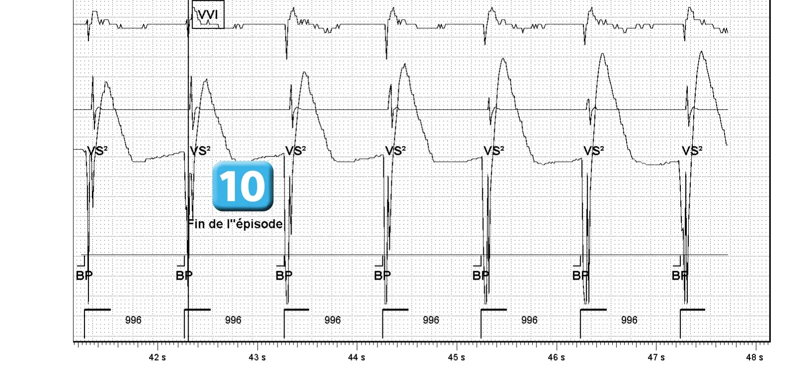 Électrogramme Abbott ICD, segment 4 sur 4 — Activation de l’algorithme VFTA pour favoriser la délivrance d’un choc électrique lors d’un épisode d’arythmie ventriculaire