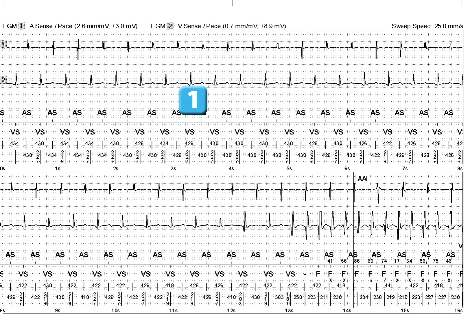 Électrogramme Abbott ICD, segment 1 sur 3 — Choc électrique et induction d’un épisode de FA