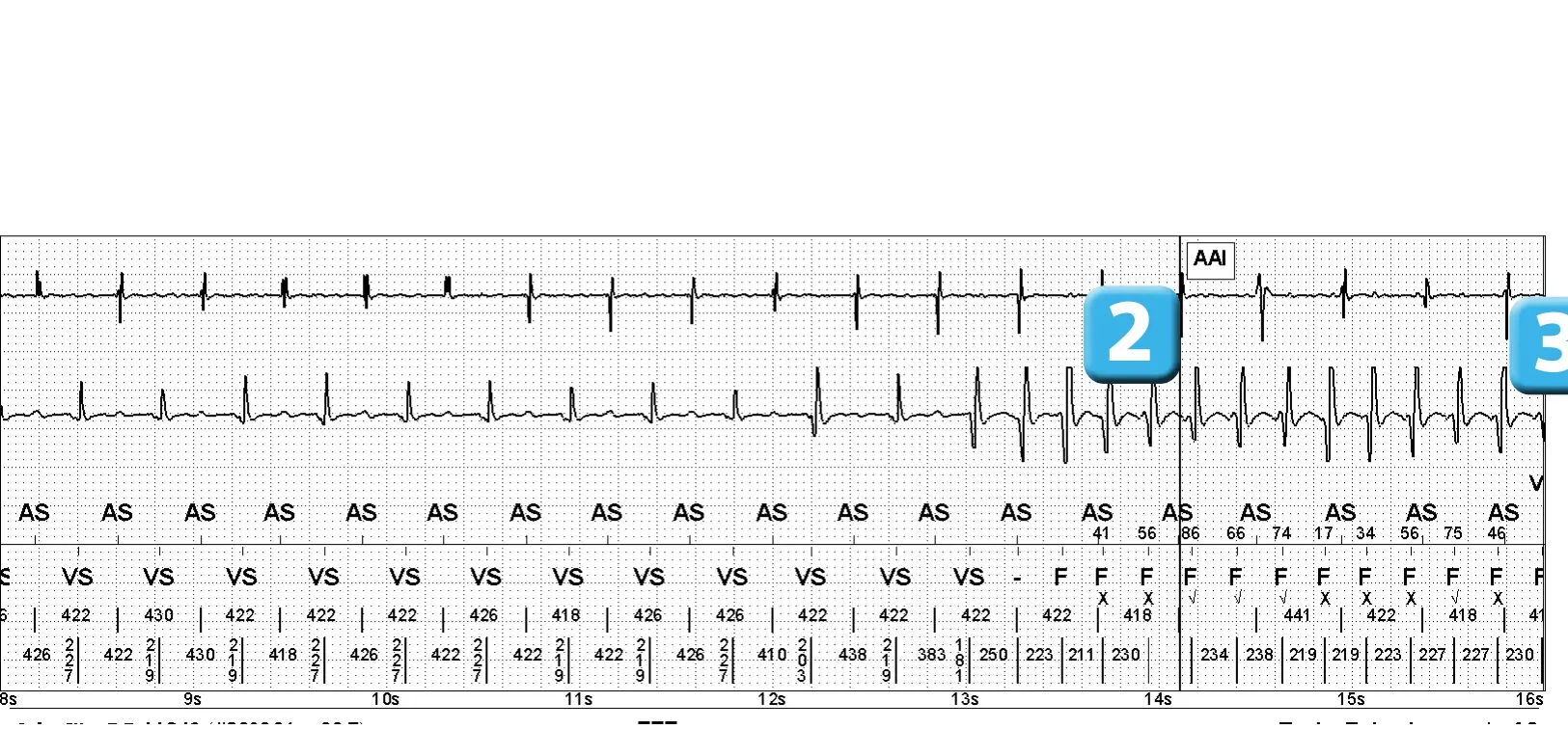Électrogramme Abbott ICD, segment 2 sur 3 — Choc électrique et induction d’un épisode de FA
