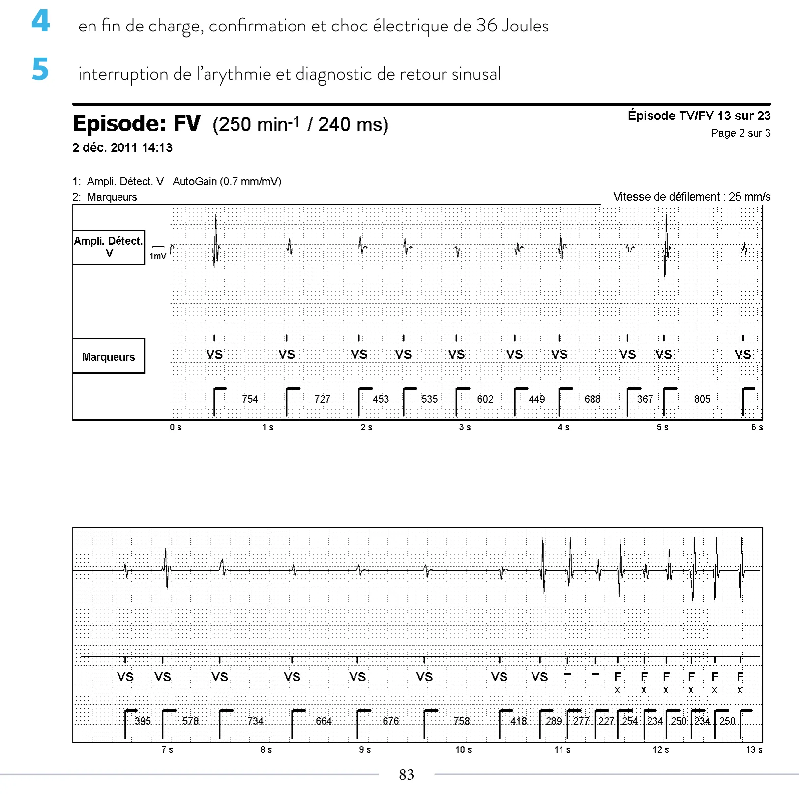 Stimulation anti-tachycardique pendant ou avant la charge en zone de FV