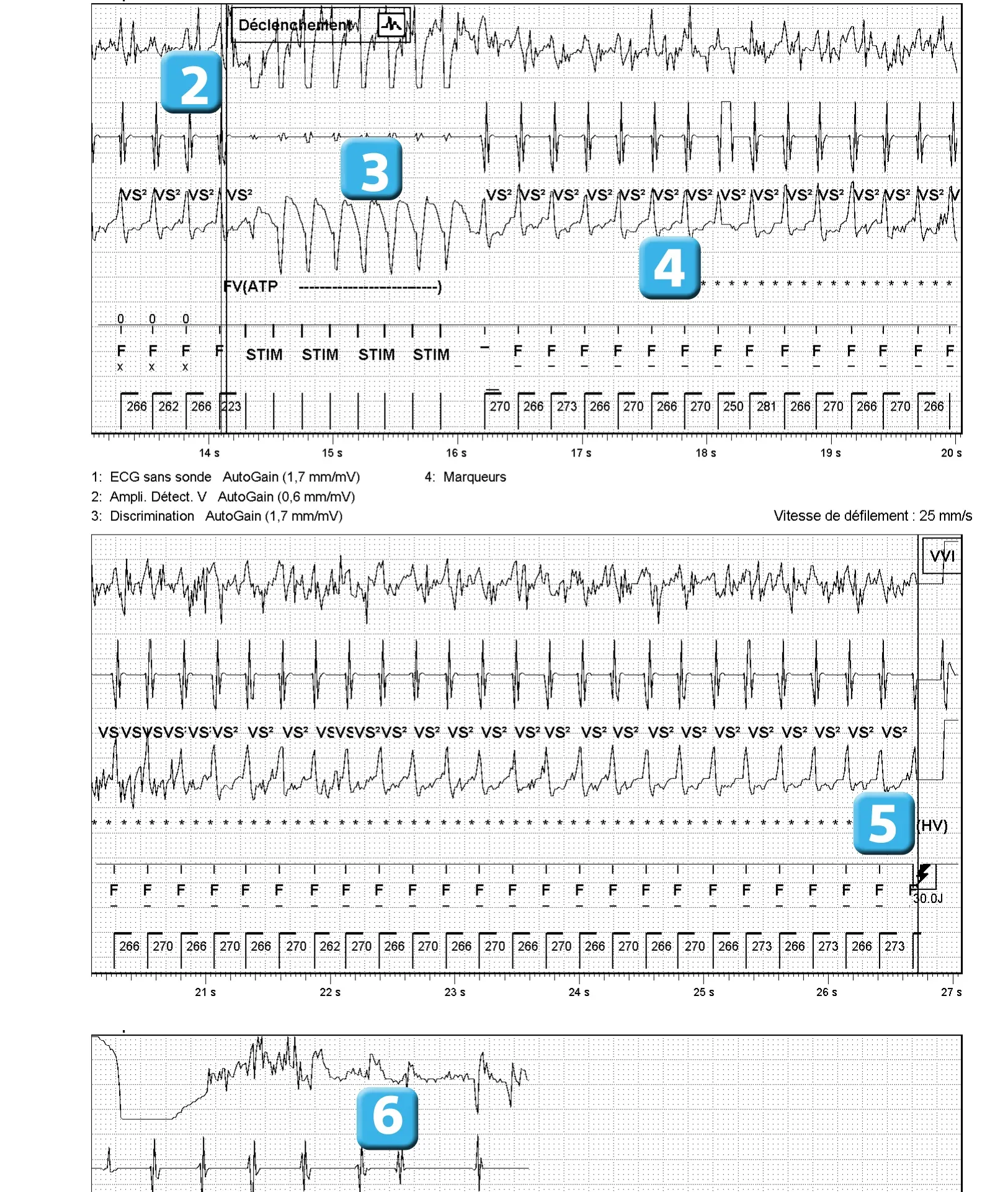 Stimulation anti-tachycardique pendant ou avant la charge en zone de FV