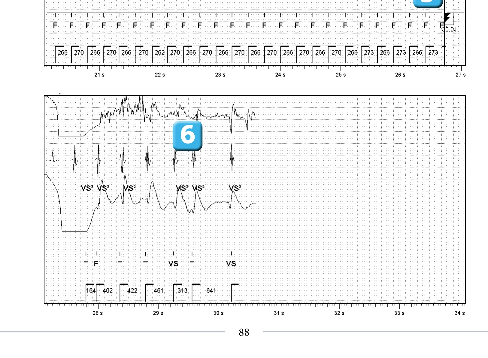 Stimulation anti-tachycardique pendant ou avant la charge en zone de FV