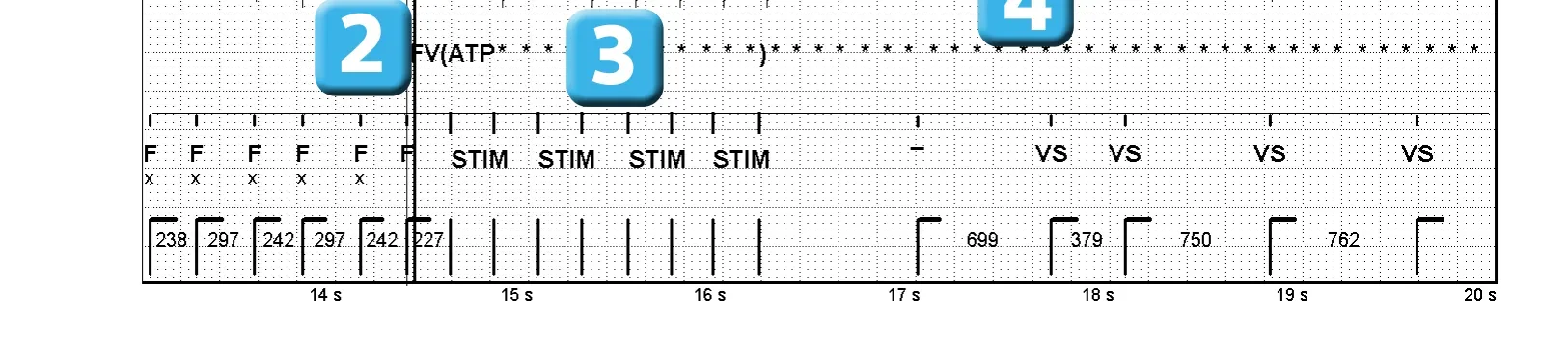Électrogramme Abbott ICD, segment 1 sur 2 — Stimulation anti-tachycardique pendant ou avant la charge en zone de FV