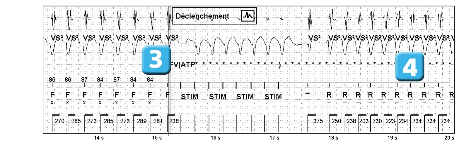 Électrogramme Abbott ICD, segment 2 sur 2 — ATP pendant la charge et accélération de la tachycardie