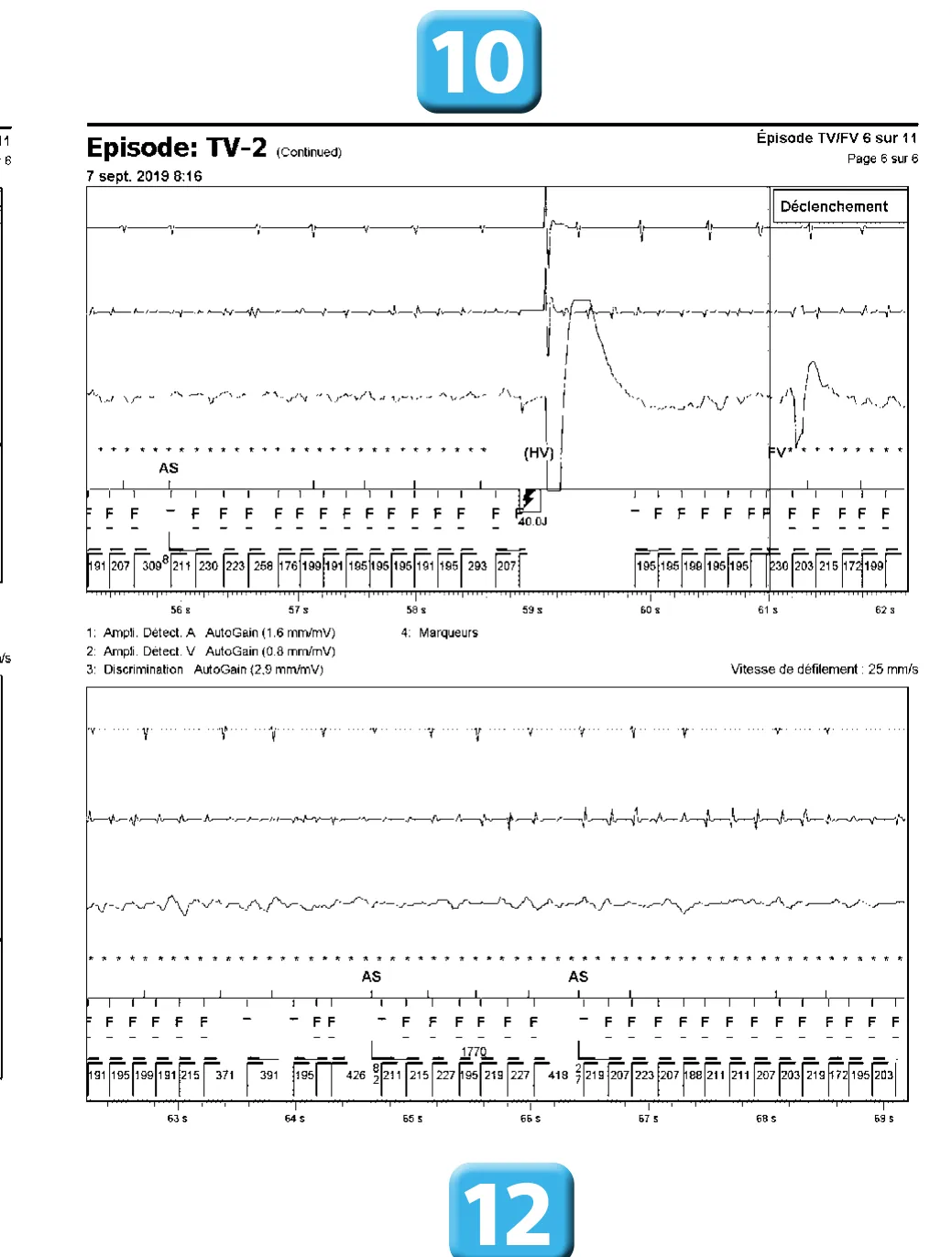 Accélération d’une TV par une stimulation anti-tachycardique et seuil de défibrillation élevé