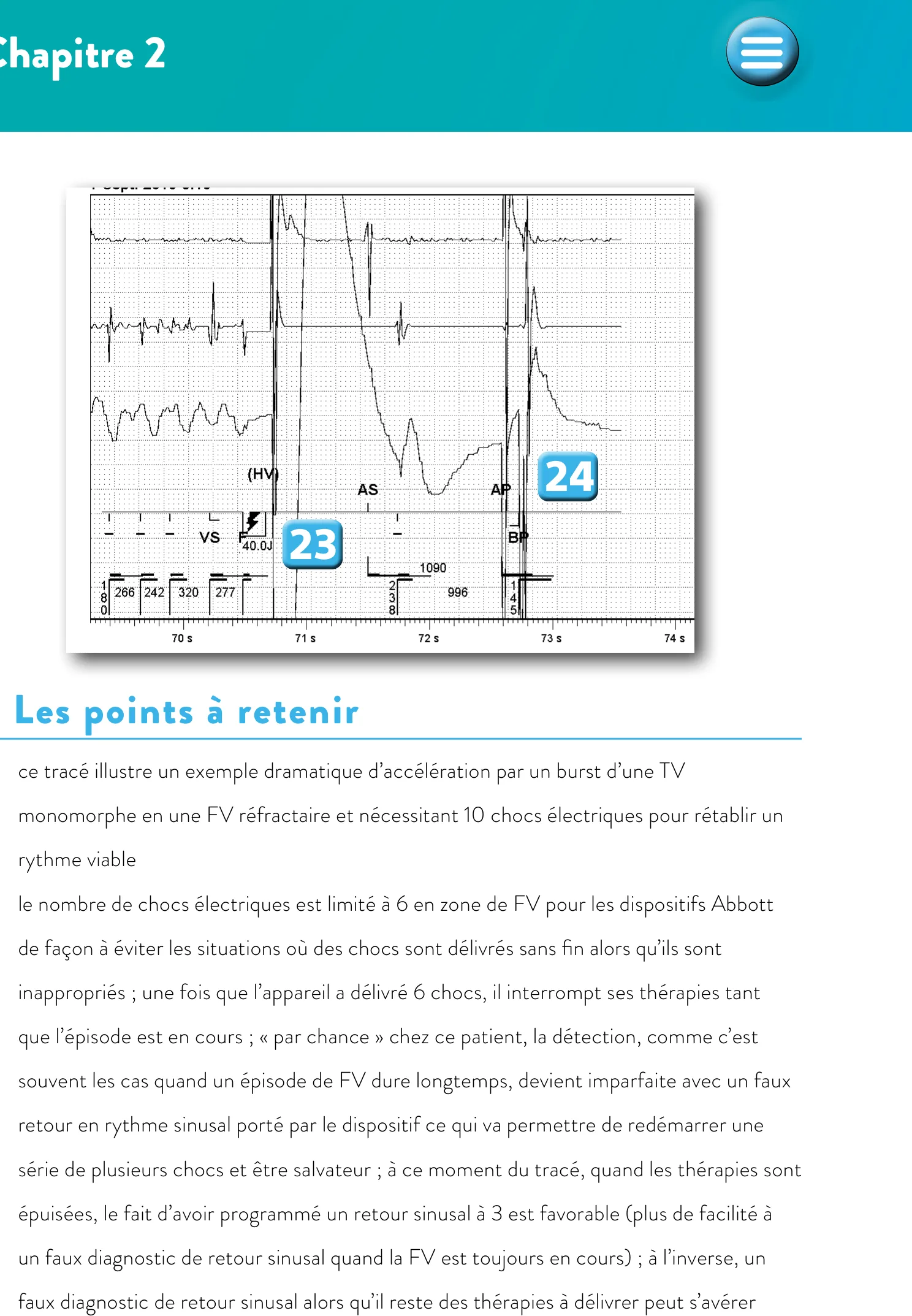 Accélération d’une TV par une stimulation anti-tachycardique et seuil de défibrillation élevé