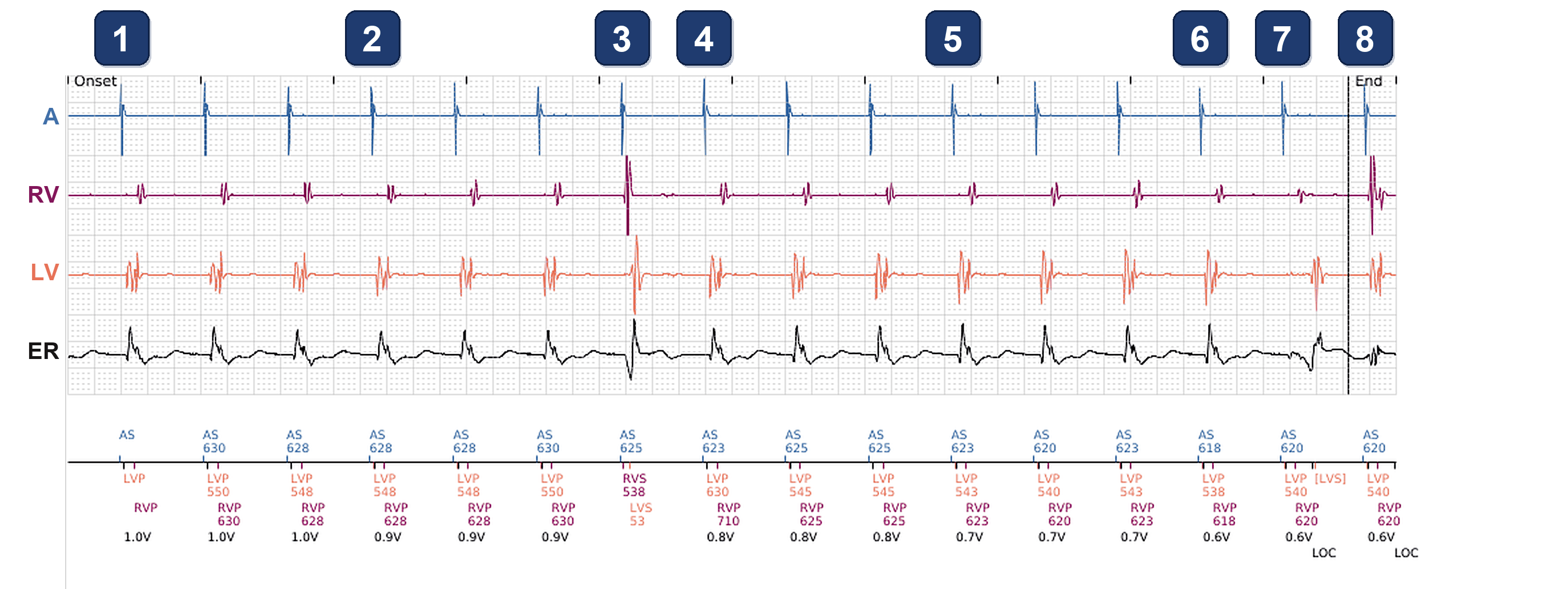 Électrogramme Boston Scientific CRT, segment 1/1 — Test PaceSafe VG et battement inattendu