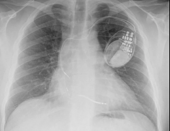 Radiographie thoracique présentée avec le cas (face) : la CRT-D et ses trois sondes, atriale, de défibrillation VD et la 3830 sur le port VG ; la 3830 est celle du milieu, la plus fine