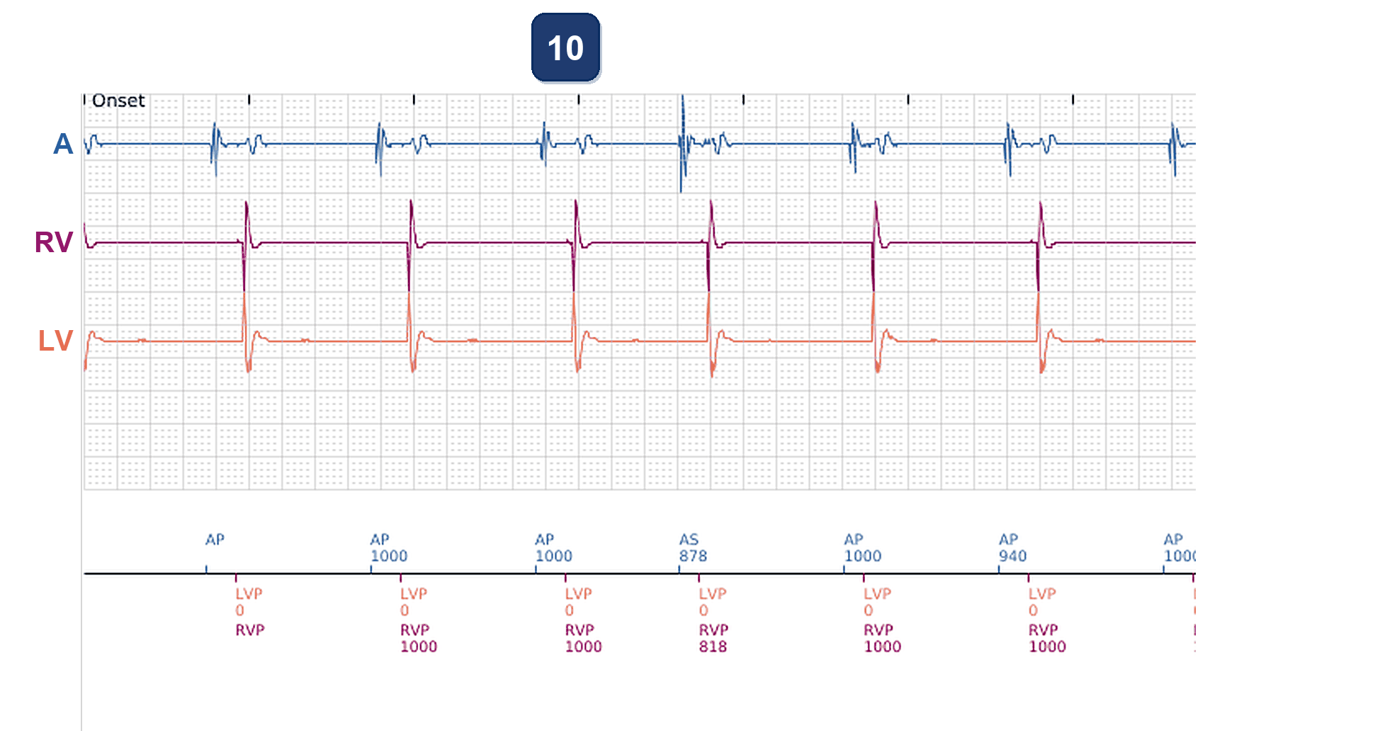 Électrogramme Boston Scientific CRT, segment 7/7 — Alerte d'impédance VG hors limites en fin de vie de pile