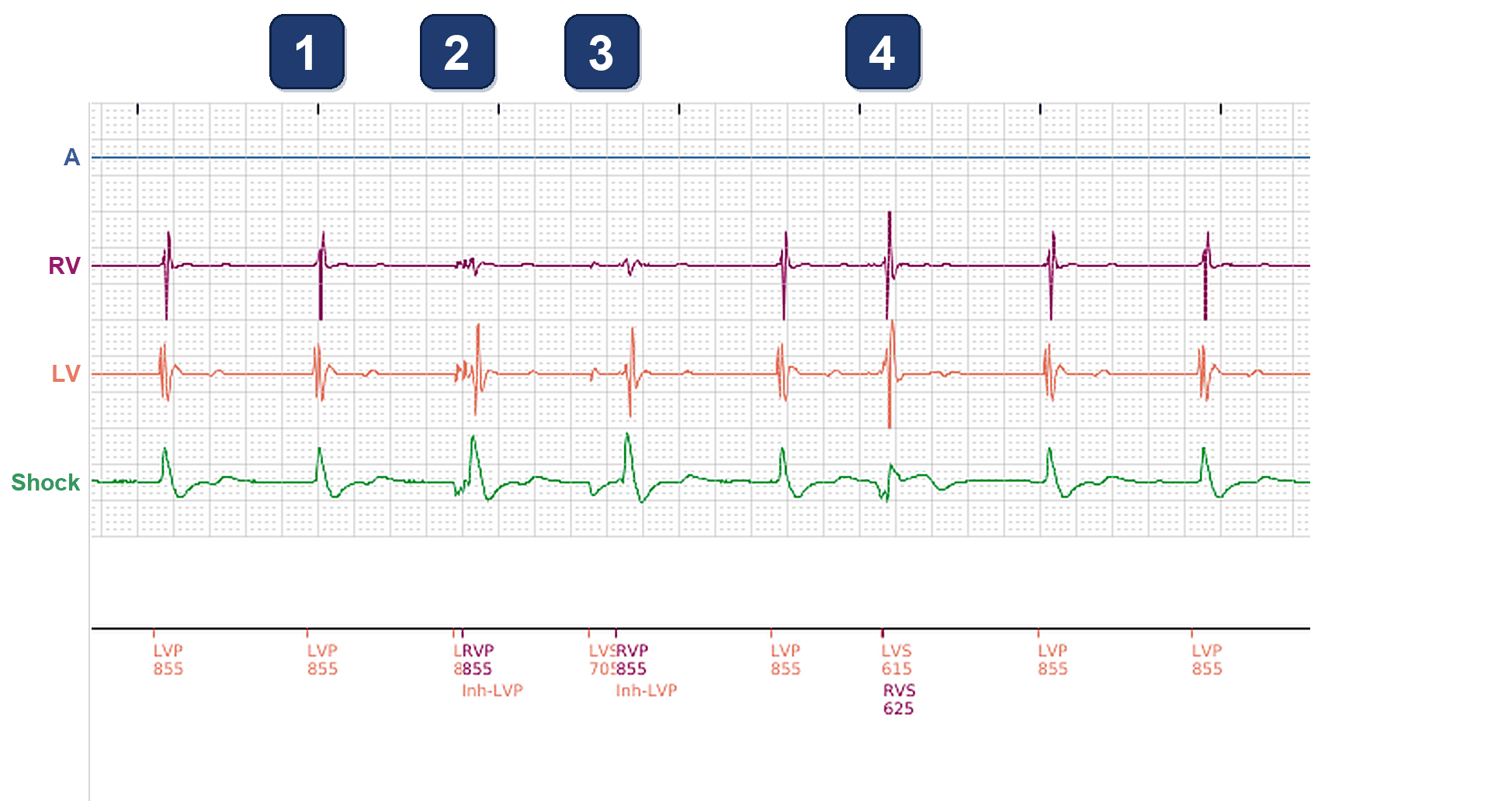 Électrogramme Boston Scientific CRT, segment 1/3 — Stimulation VG seule avec surdétection sur la voie VG et sur la voie VD