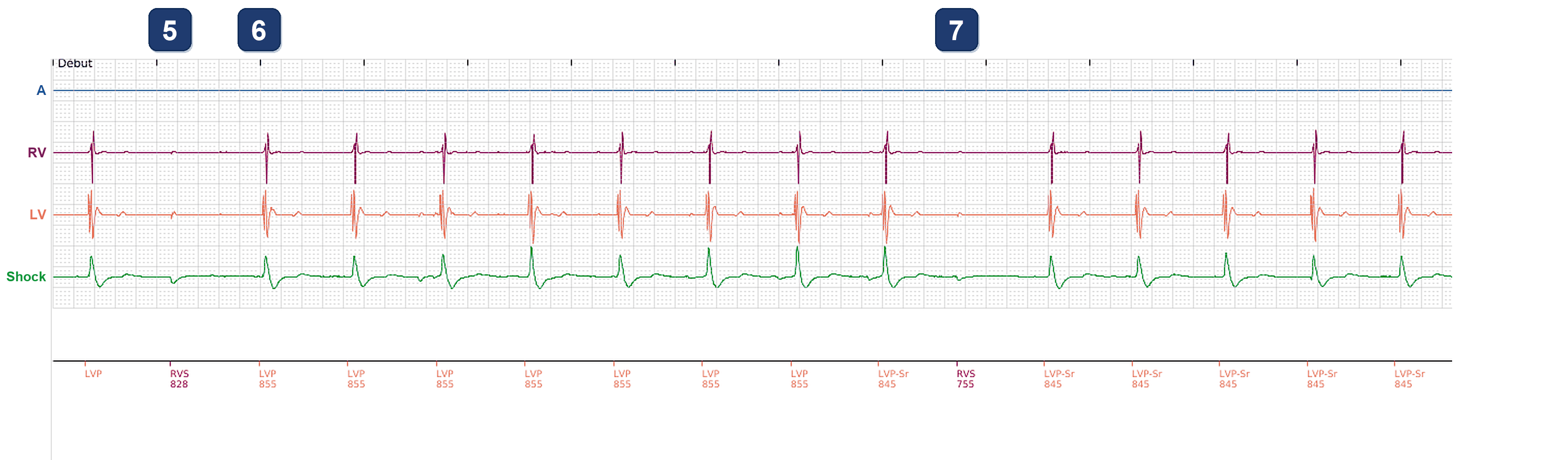 Électrogramme Boston Scientific CRT, segment 3/3 — Stimulation VG seule avec surdétection sur la voie VG et sur la voie VD