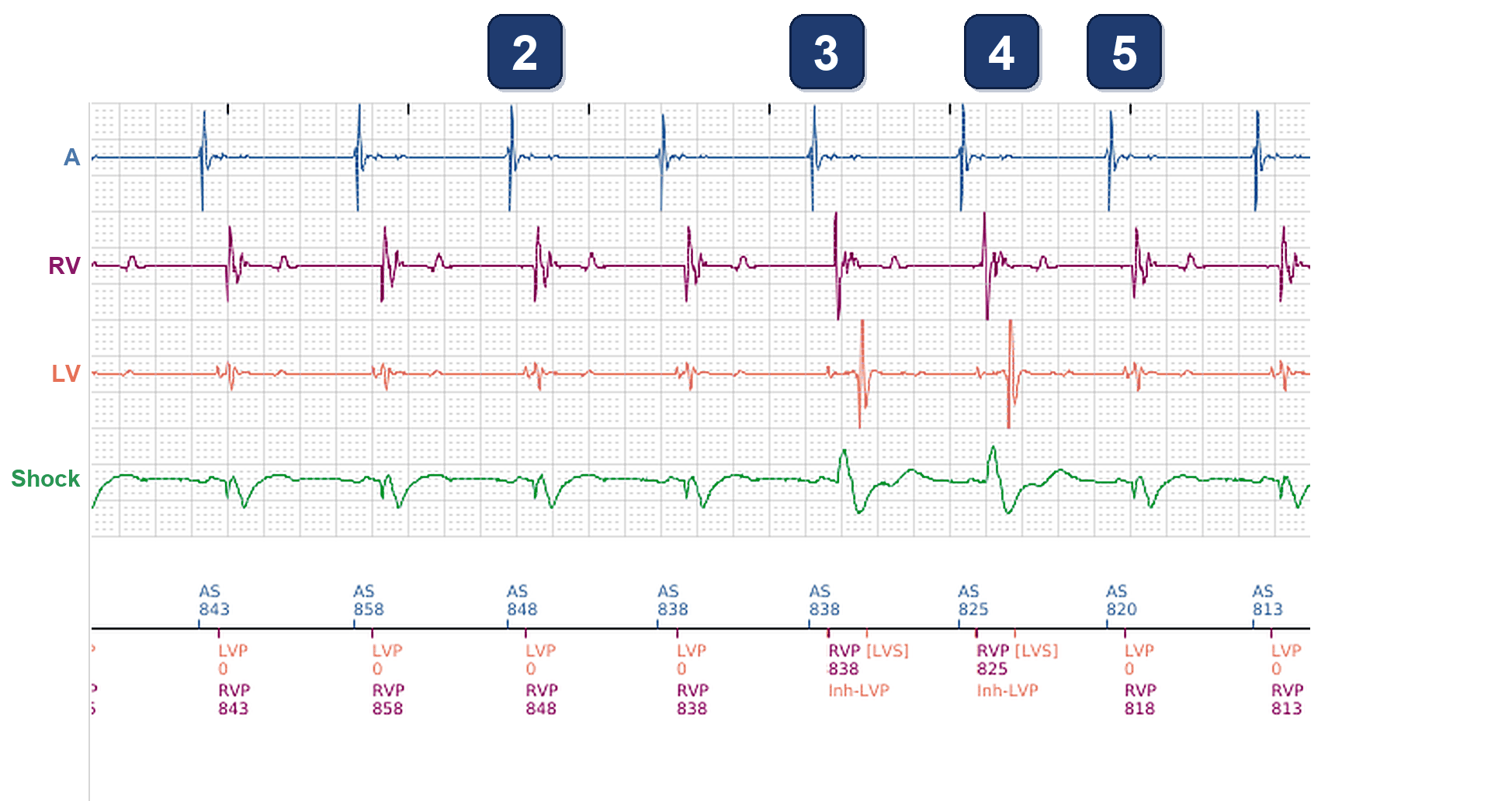 Électrogramme Boston Scientific CRT, segment 2/3 — Perte intermittente de la stimulation VG malgré 99 % de stimulation VD