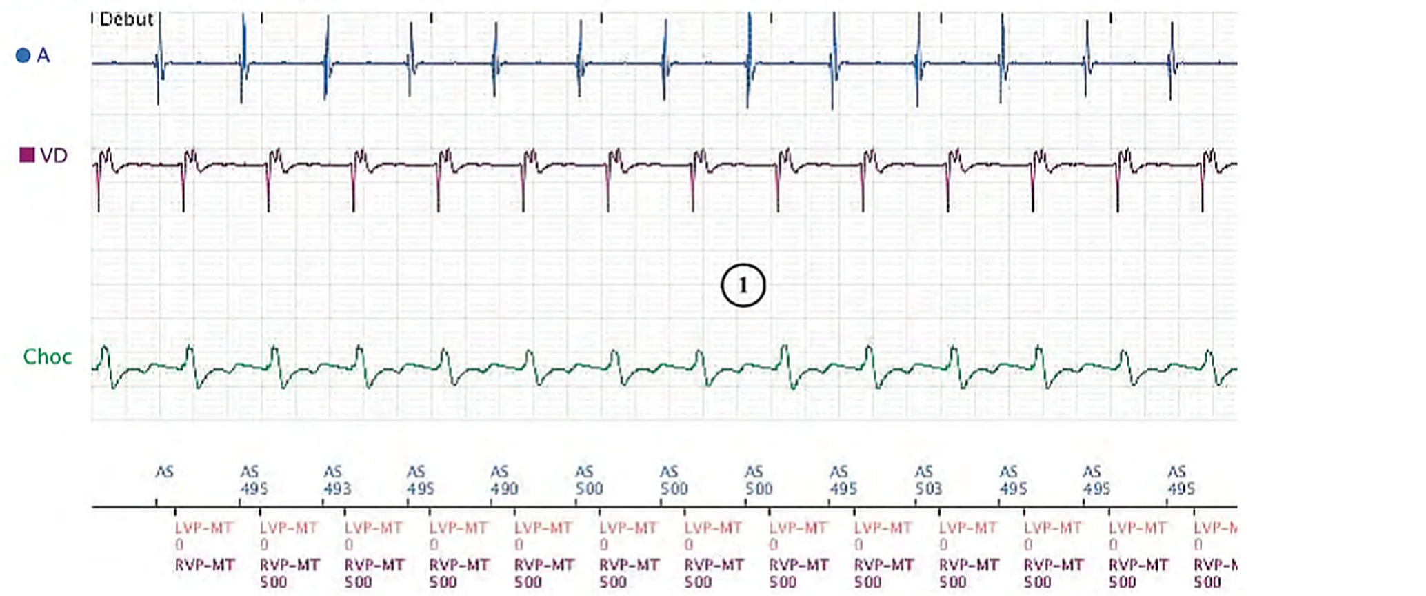 Électrogramme Boston Scientific CRT, segment 1/8 — Tachycardie sinusale, Wenckebach et effet pro-arythmogène