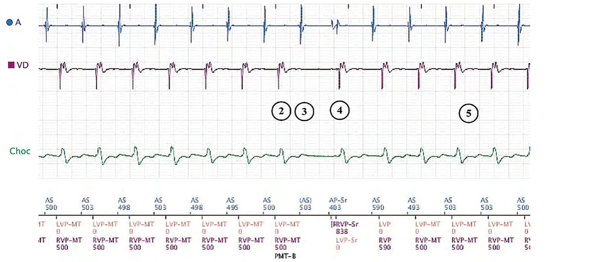 Électrogramme Boston Scientific CRT, segment 2/8 — Tachycardie sinusale, Wenckebach et effet pro-arythmogène