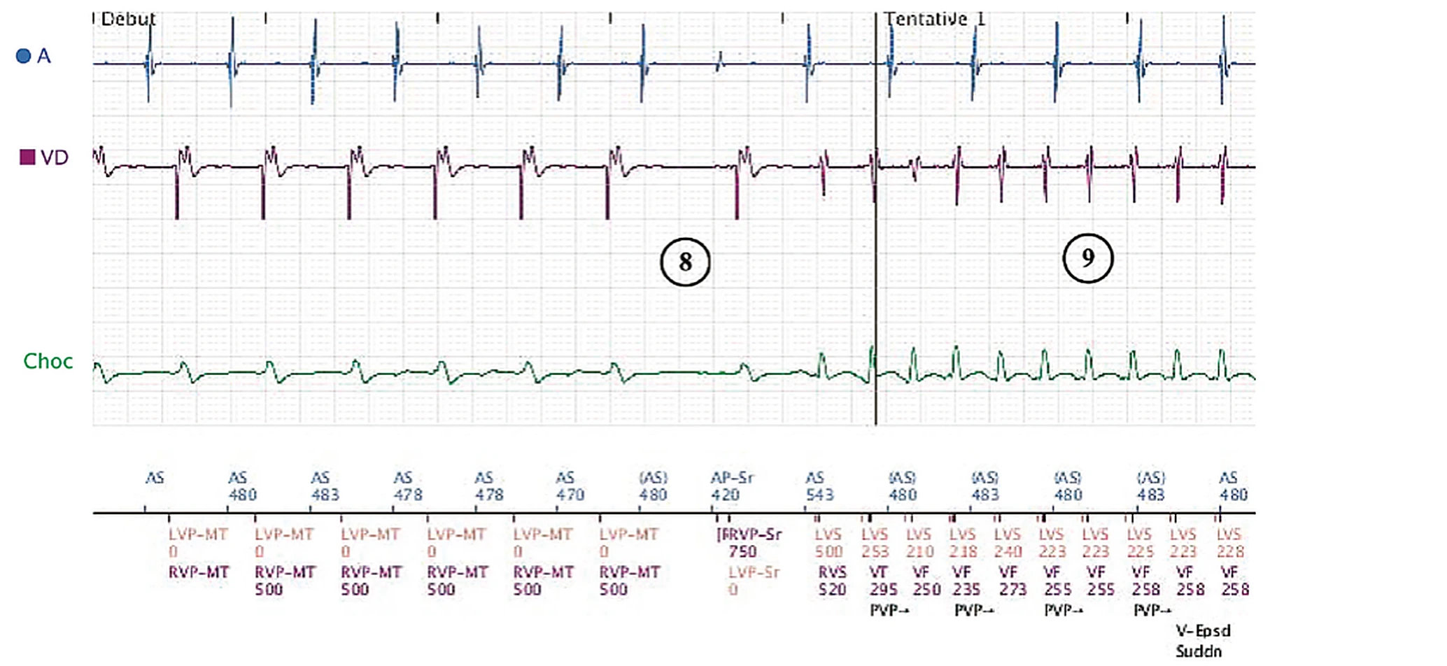 Électrogramme Boston Scientific CRT, segment 7/8 — Tachycardie sinusale, Wenckebach et effet pro-arythmogène