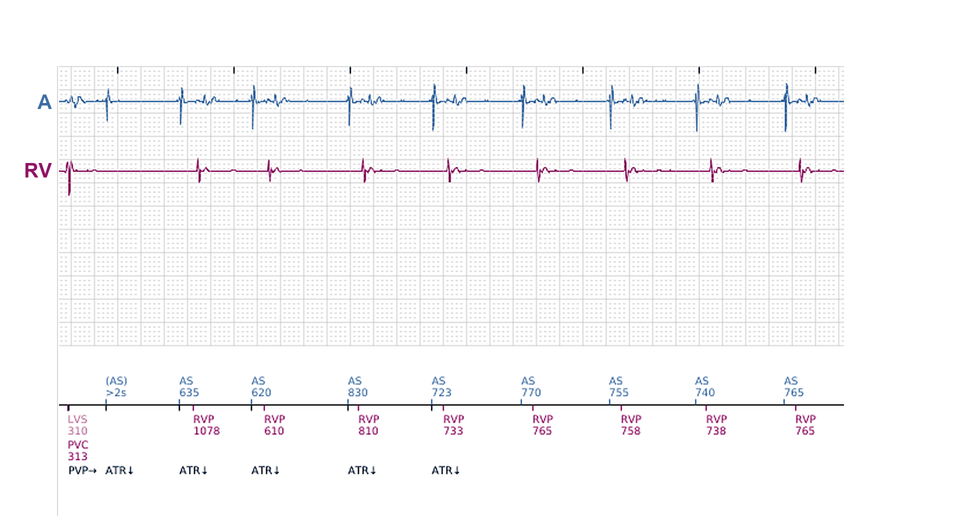 Électrogramme Boston Scientific CRT, segment 10/11 — Épisodes ventriculaires sur un CRT-P : qui les a déclenchés ?
