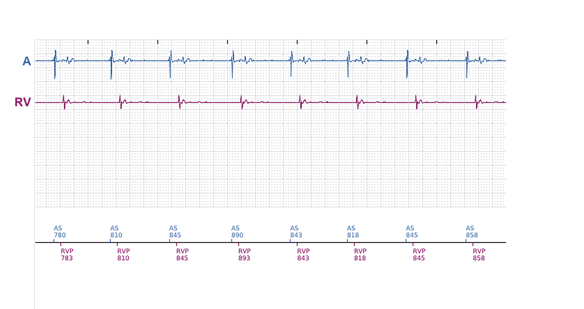 Électrogramme Boston Scientific CRT, segment 11/11 — Épisodes ventriculaires sur un CRT-P : qui les a déclenchés ?