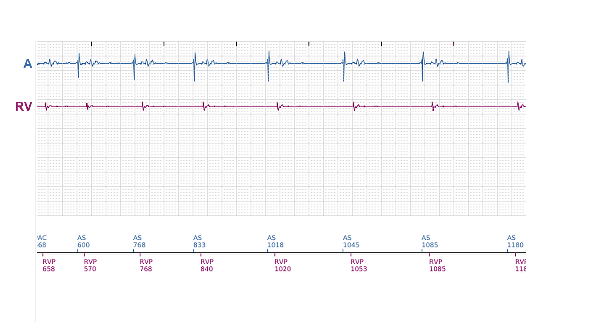 Électrogramme Boston Scientific CRT, segment 5/11 — Épisodes ventriculaires sur un CRT-P : qui les a déclenchés ?