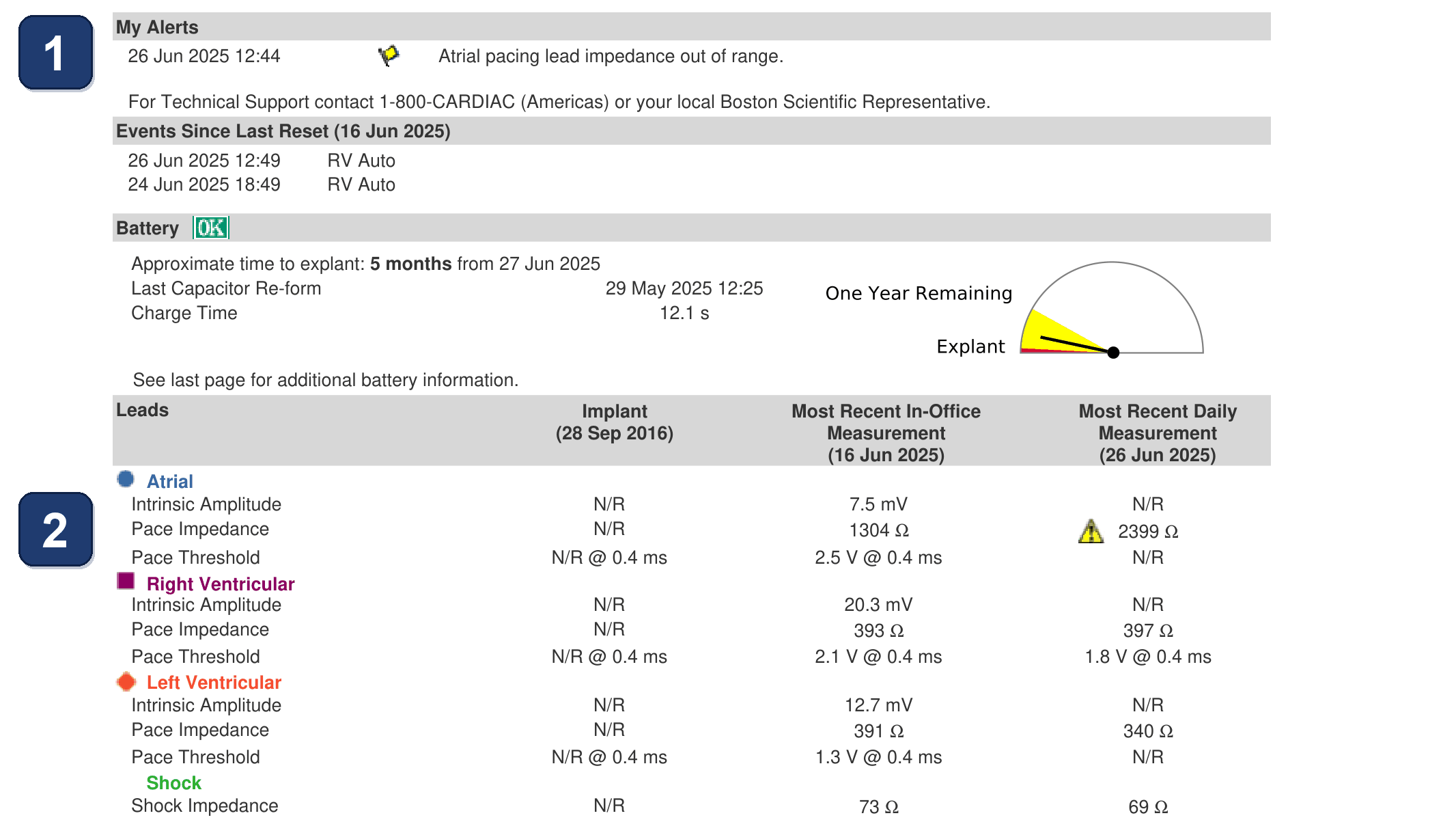 Électrogramme Boston Scientific CRT, segment 1/3 — Alerte d'impédance de sonde OD chez un patient stimulé
