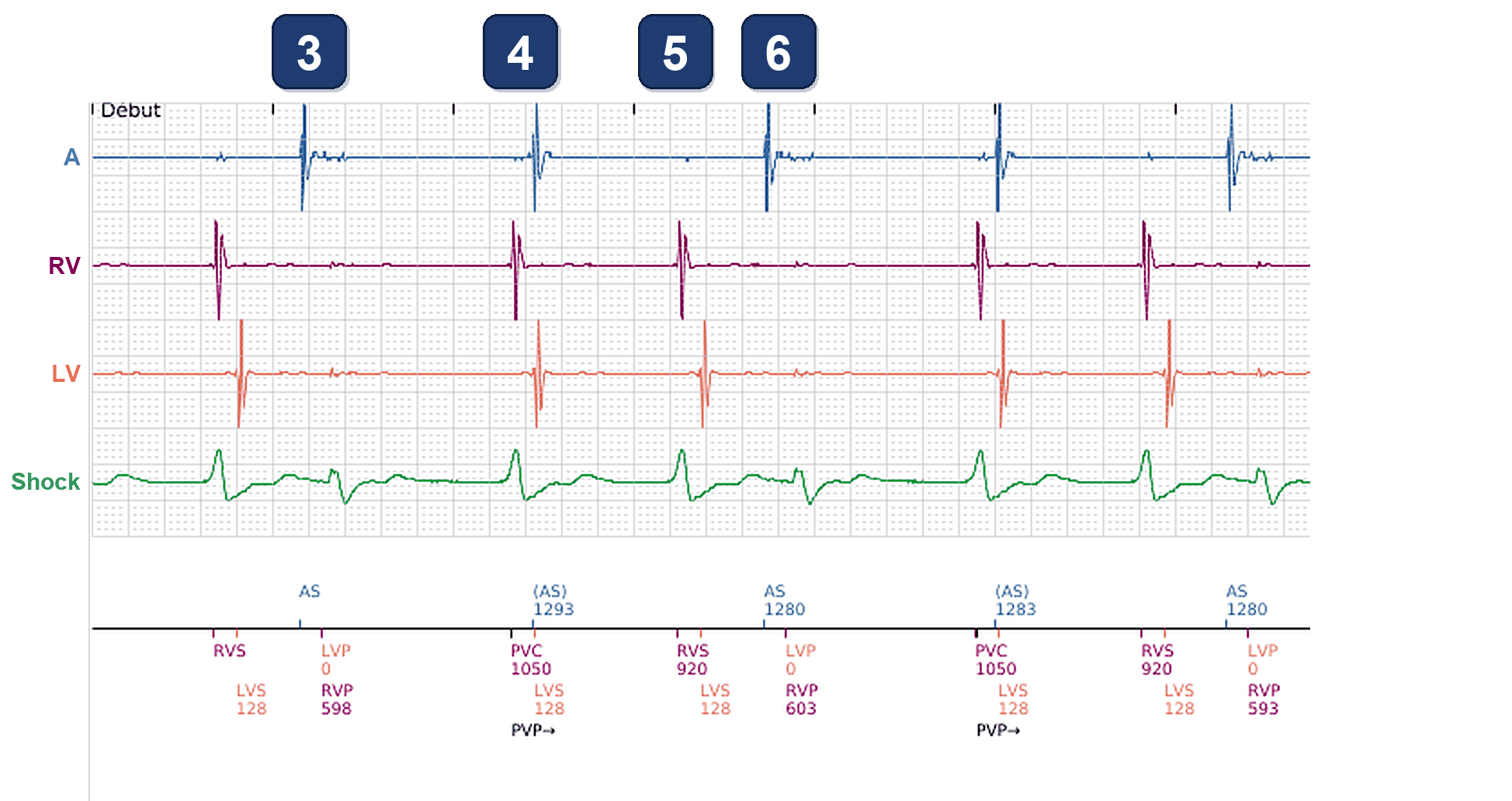 Électrogramme Boston Scientific CRT, segment 2/4 — Perte de resynchronisation au repos sur bradycardie sinusale