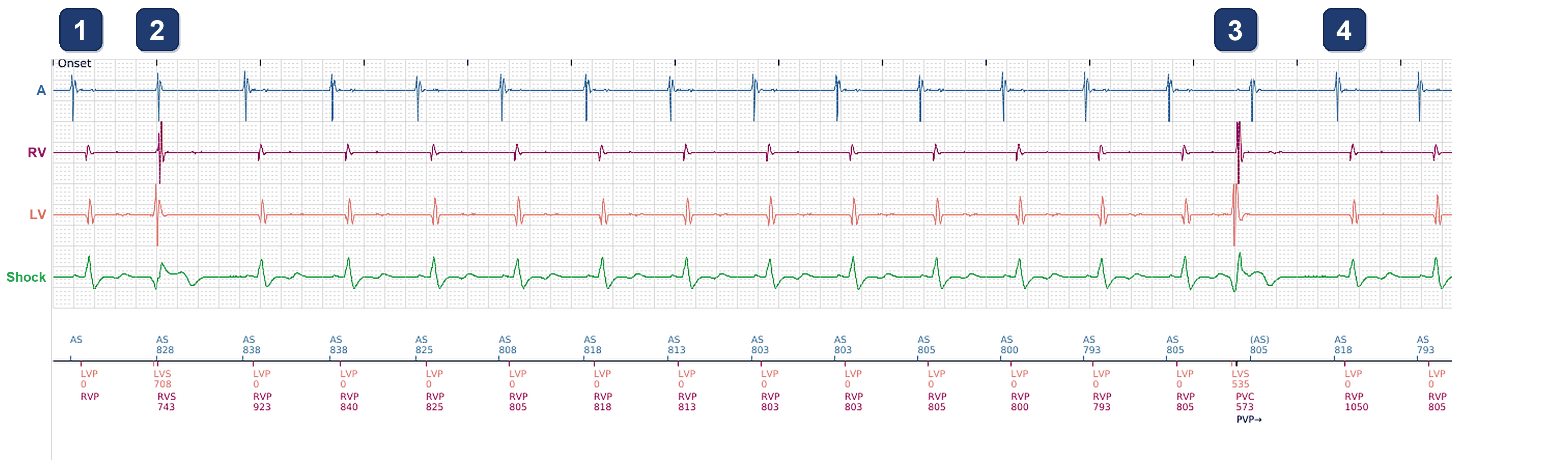 Électrogramme Boston Scientific CRT, segment 1/3 — CRT-D en rythme sinusal, stimulation BiV à 89 %
