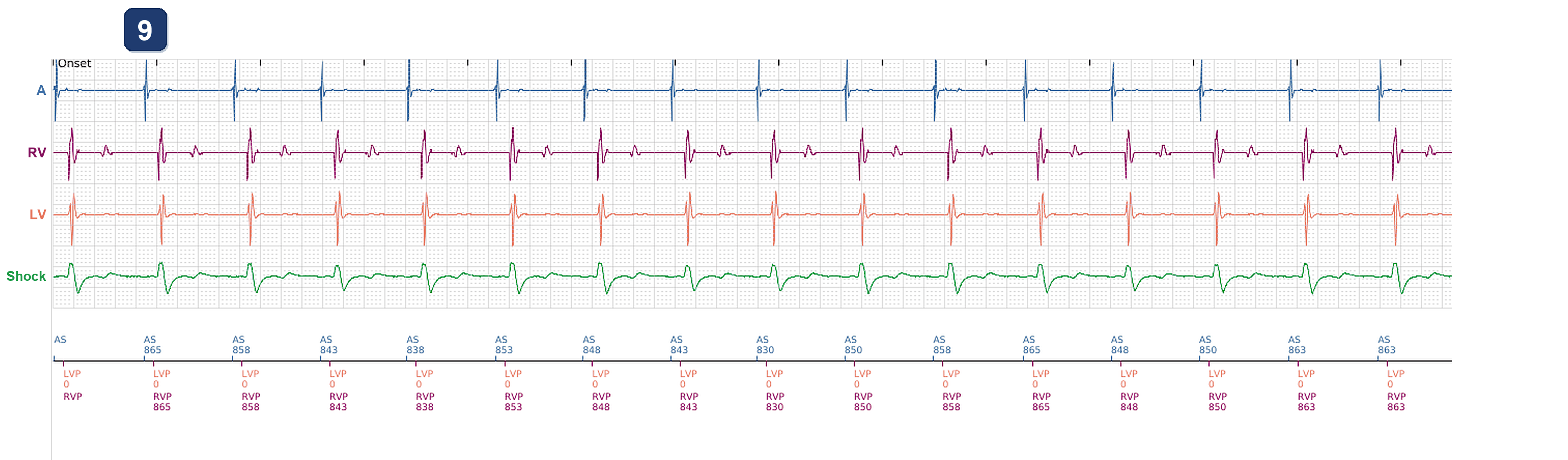 Électrogramme Boston Scientific CRT, segment 5/5 — Alerte de stimulation CRT à 57 %, puis 2 ans plus tard