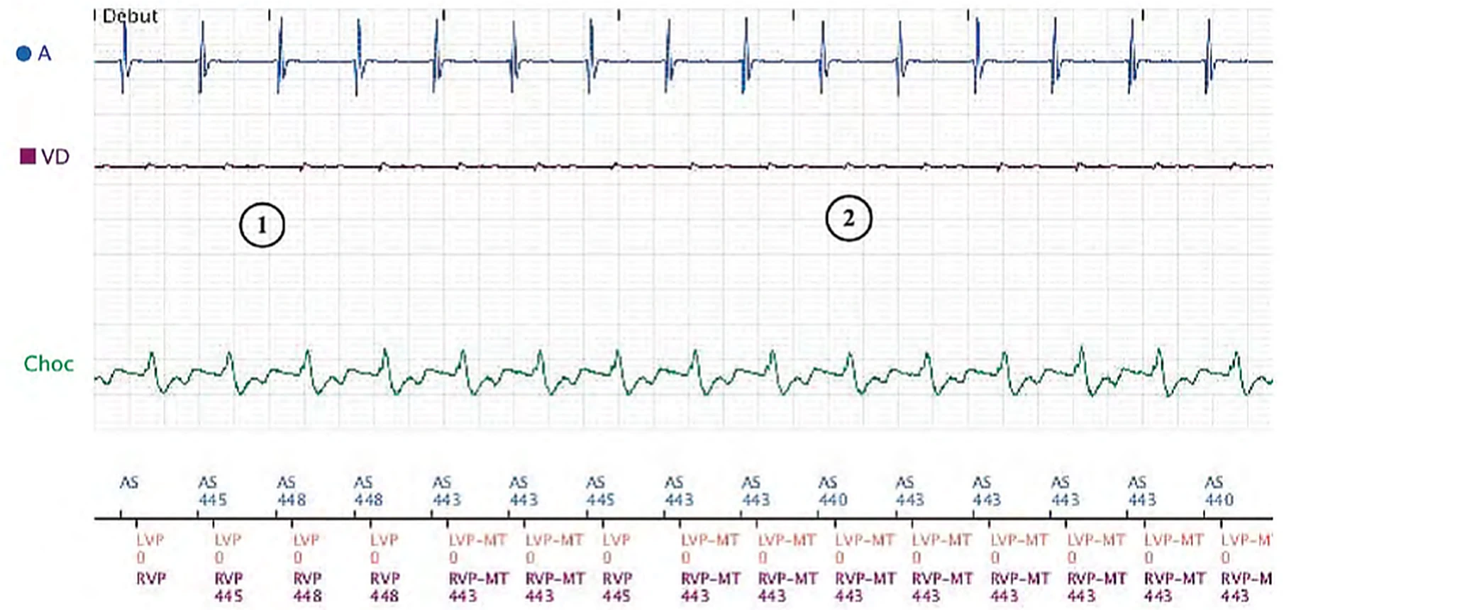 Électrogramme Boston Scientific CRT, segment 1/3 — Effort, algorithme anti-TRE et PR long