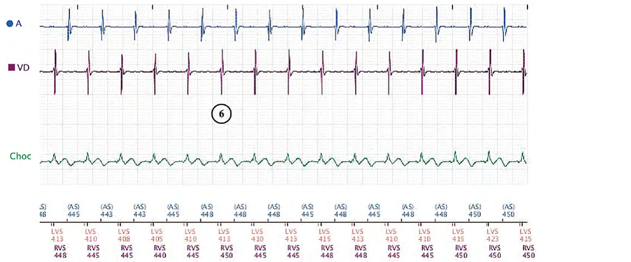 Électrogramme Boston Scientific CRT, segment 3/3 — Effort, algorithme anti-TRE et PR long